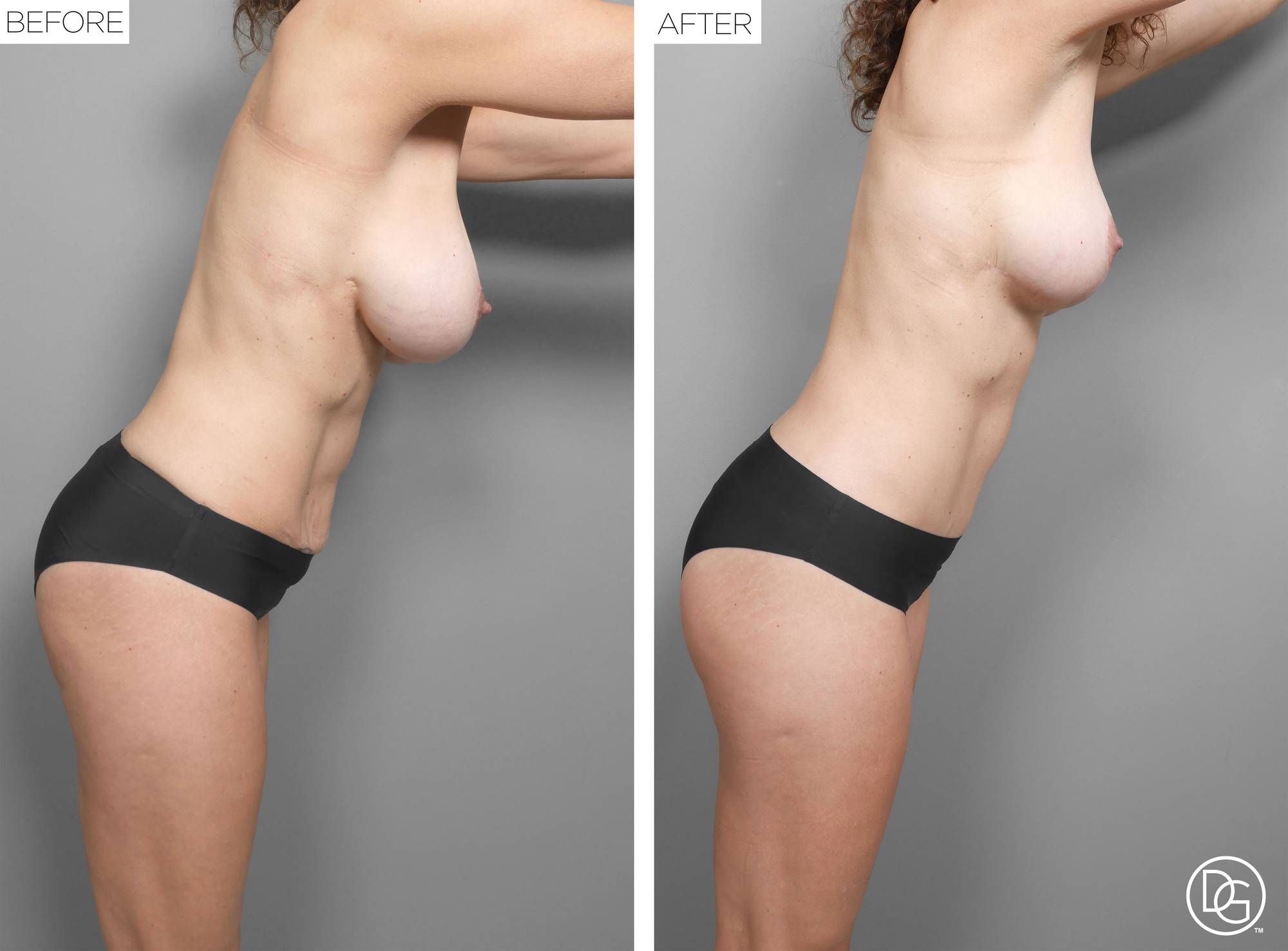 Mommy Makeover Before & After Image