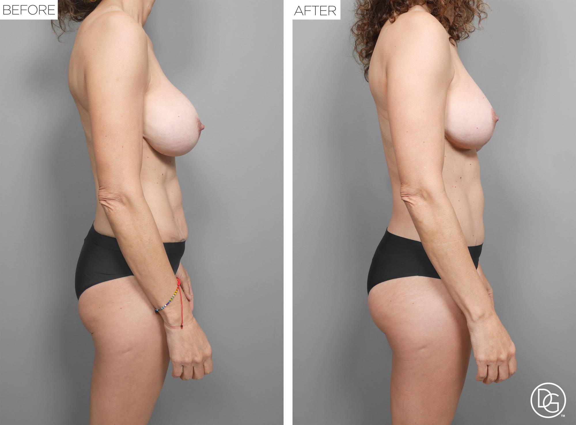 Mommy Makeover Before & After Image