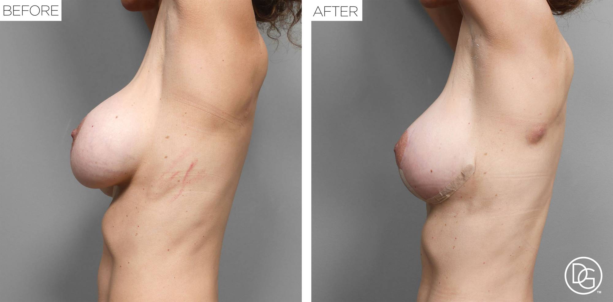 Breast Lift Before & After Image
