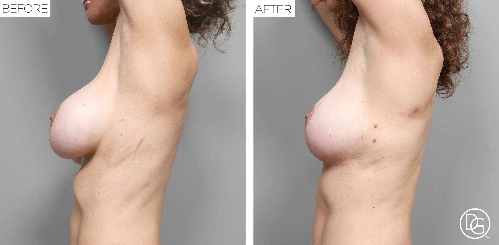 Breast Lift Before & After Image