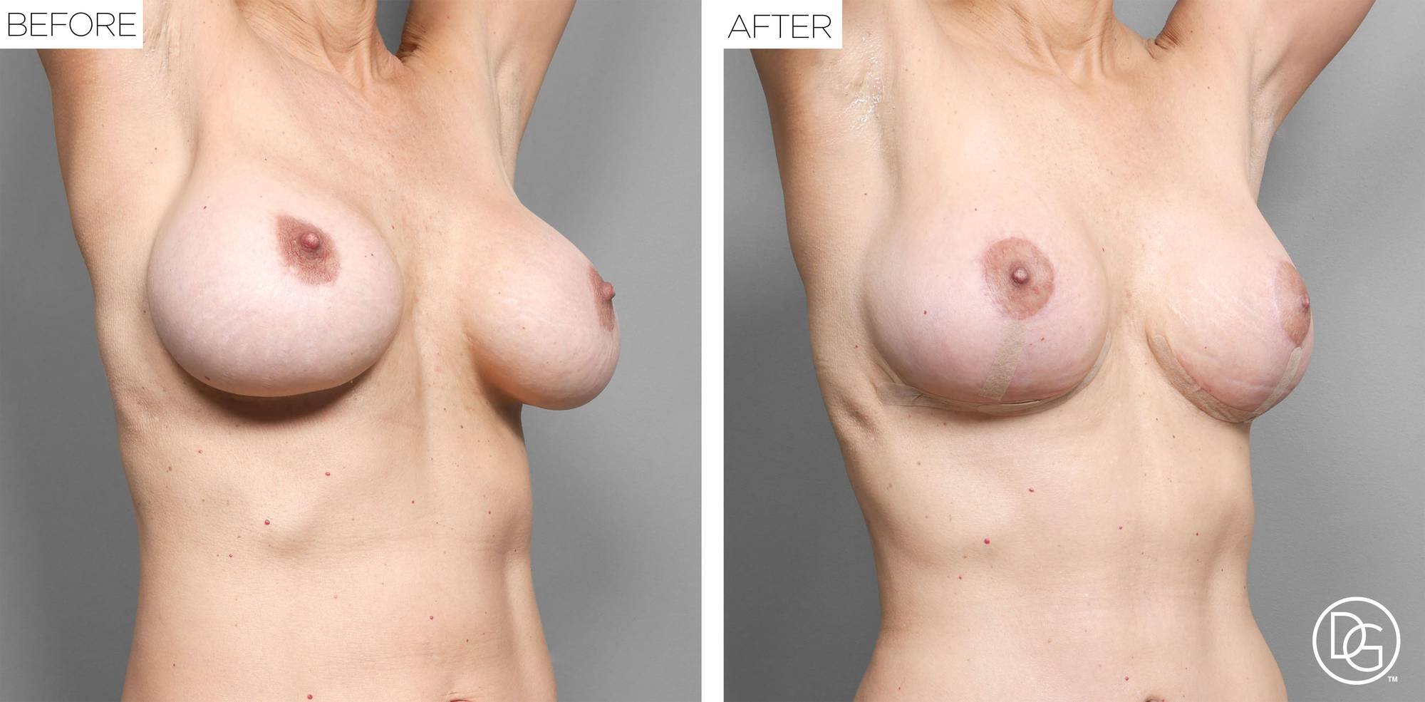 Breast Lift Before & After Image