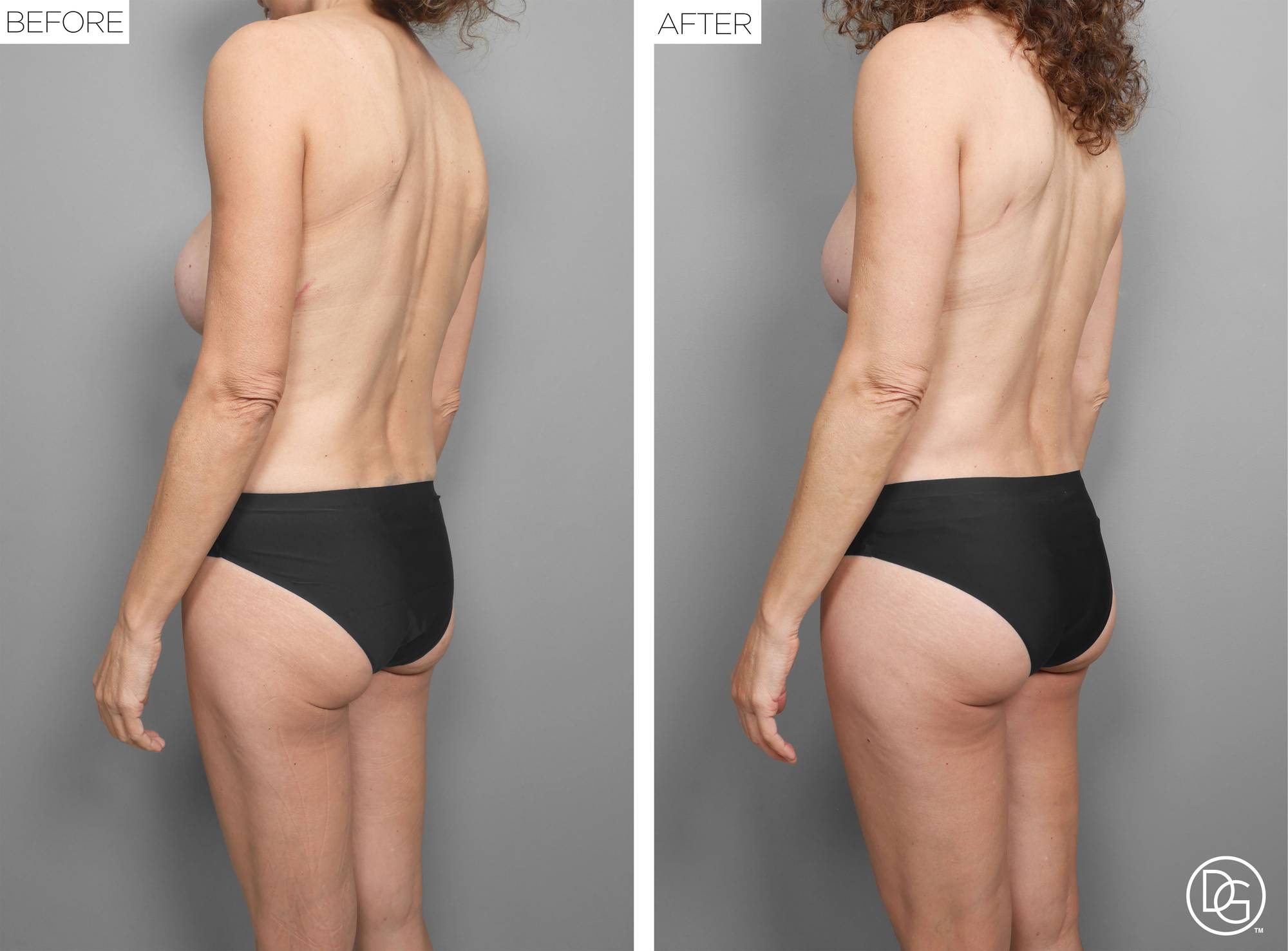 Back Lift Before & After Image