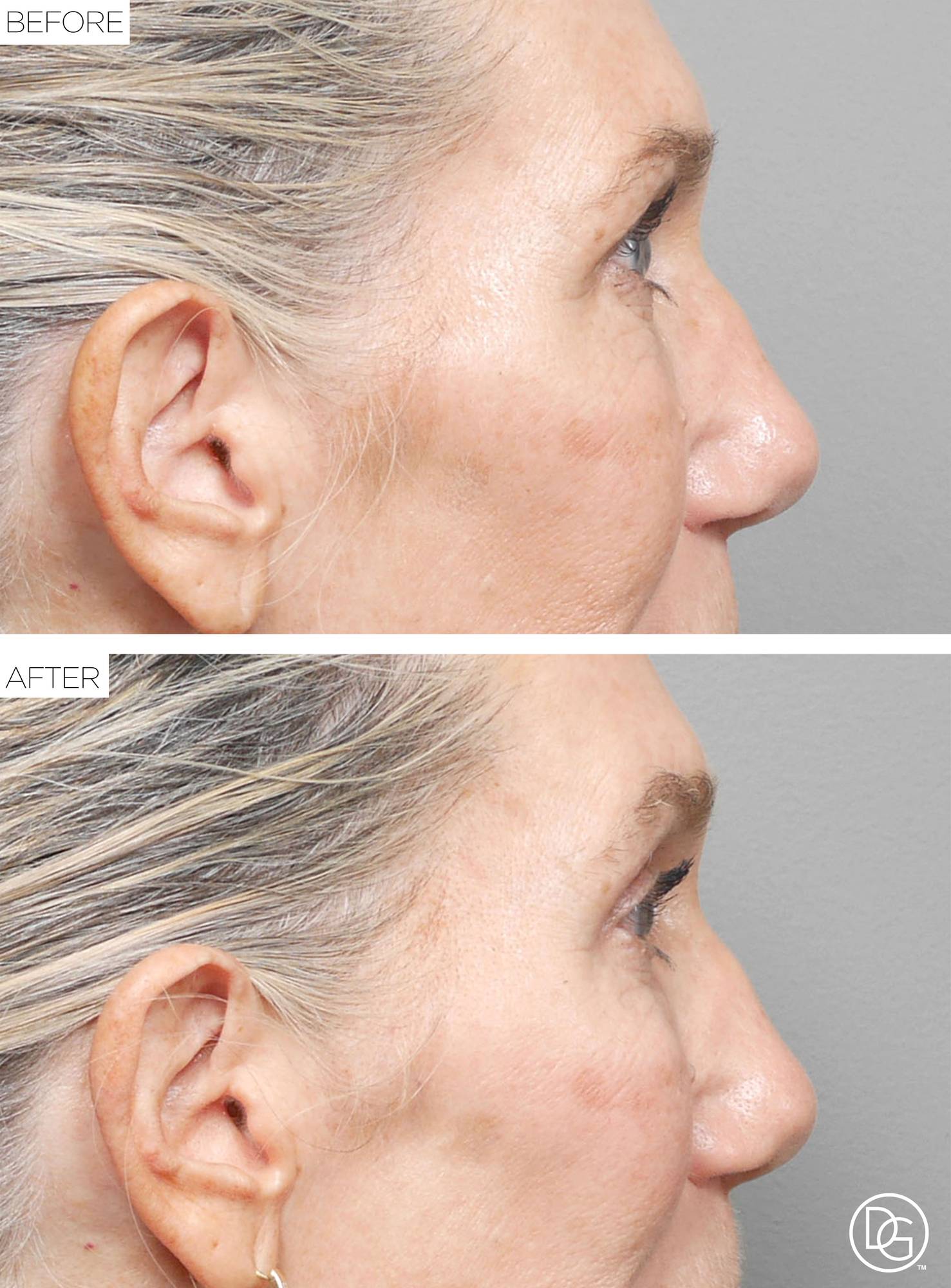 Blepharoplasty Before & After Image