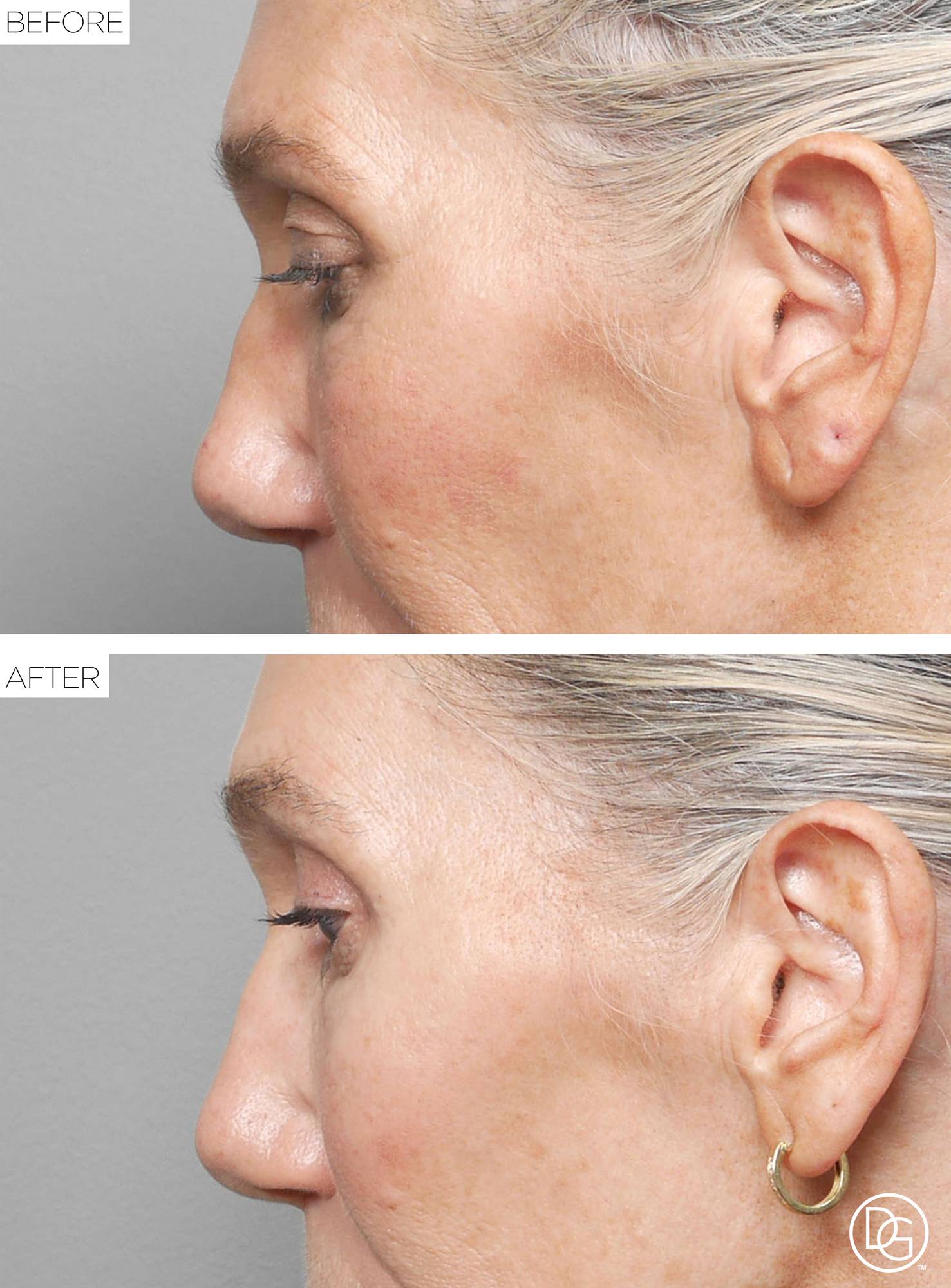 Blepharoplasty Before & After Image