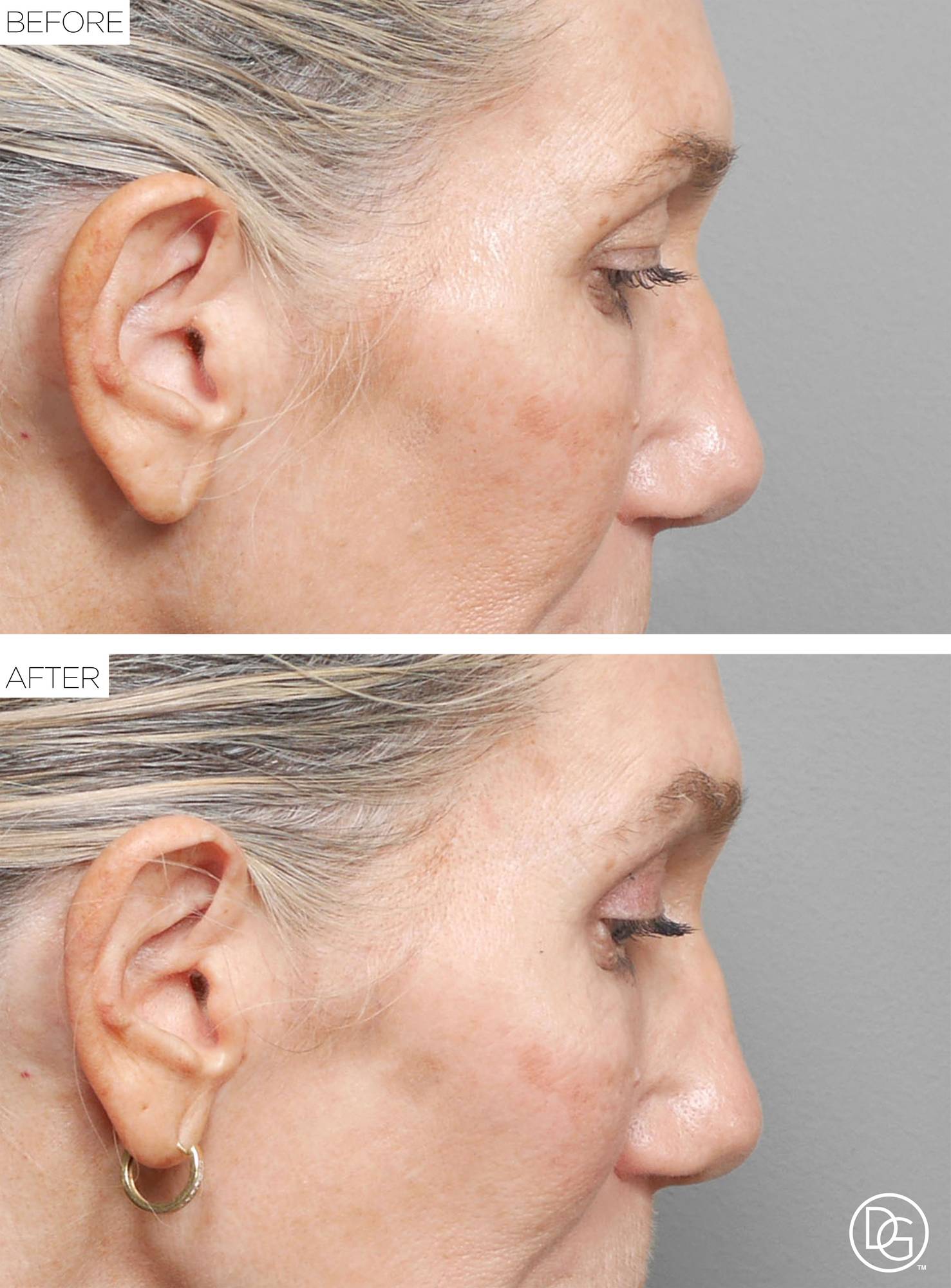 Blepharoplasty Before & After Image