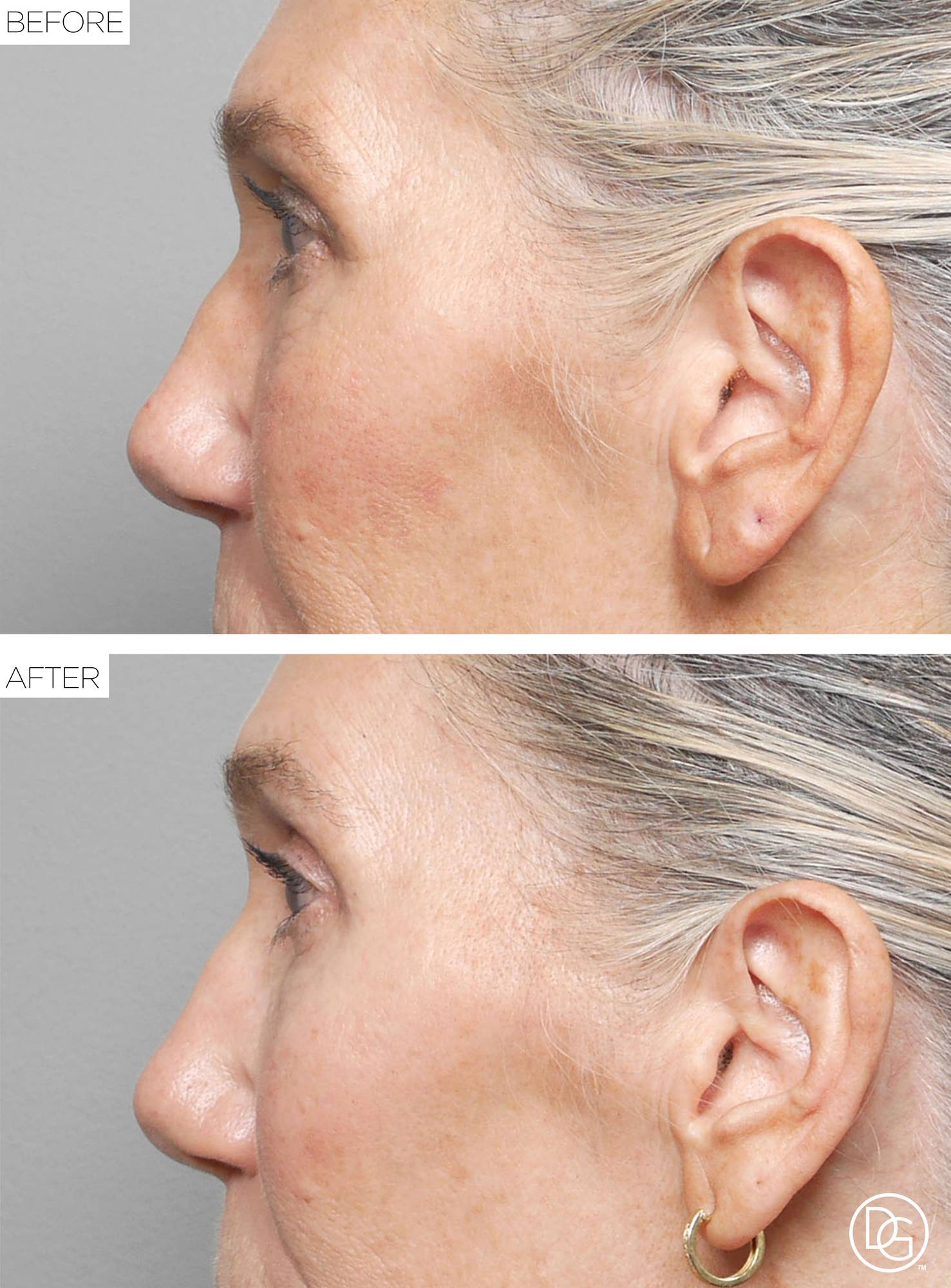 Blepharoplasty Before & After Image