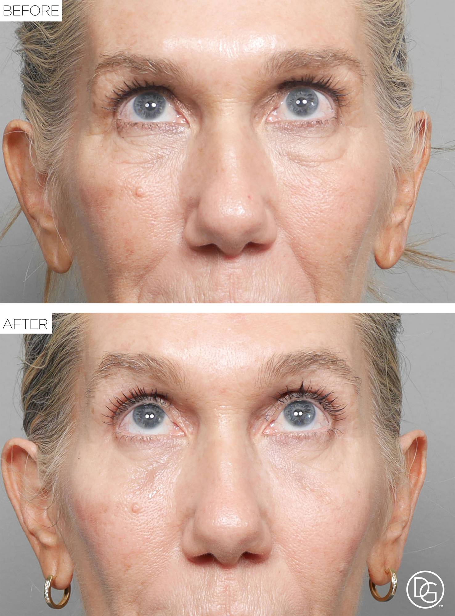 Blepharoplasty Before & After Image