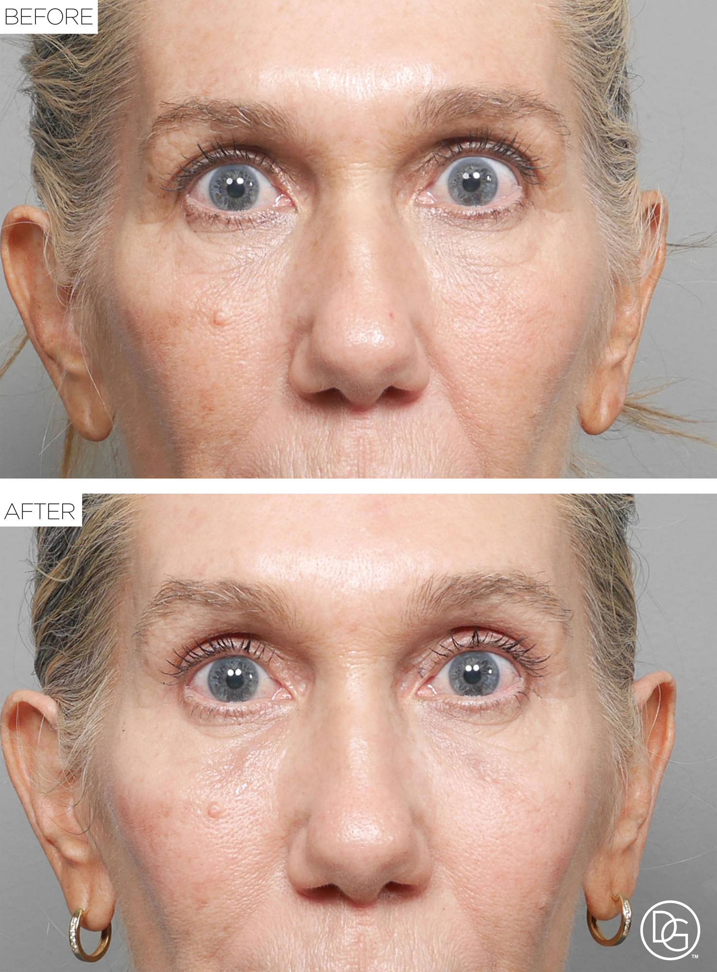 Blepharoplasty Before & After Image