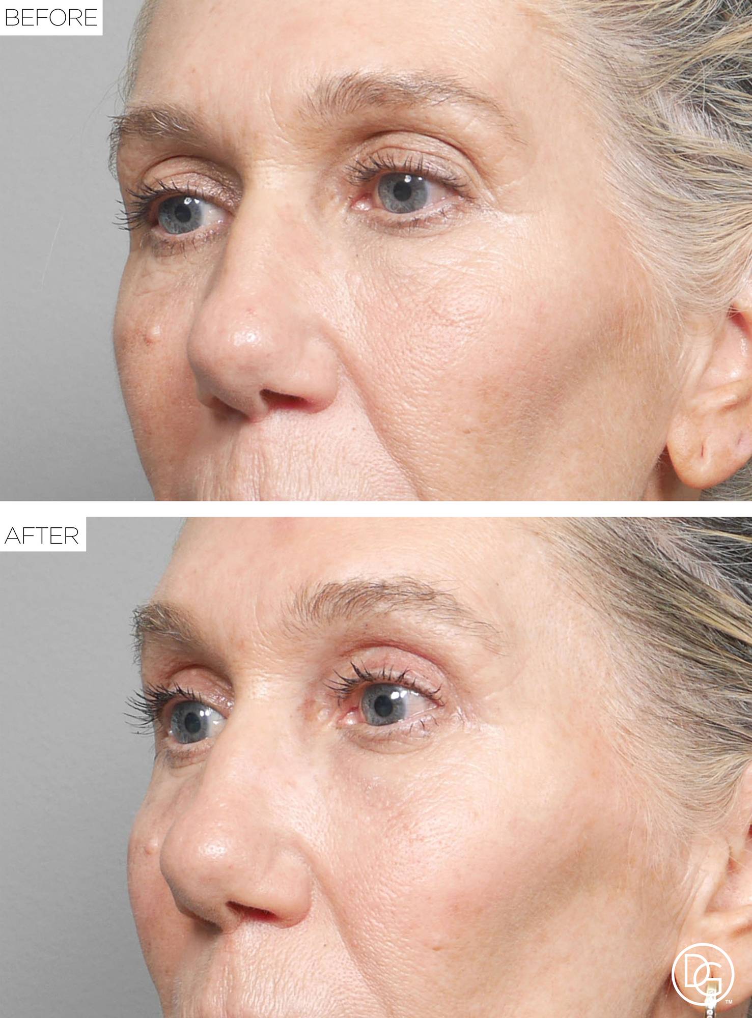 Blepharoplasty Before & After Image