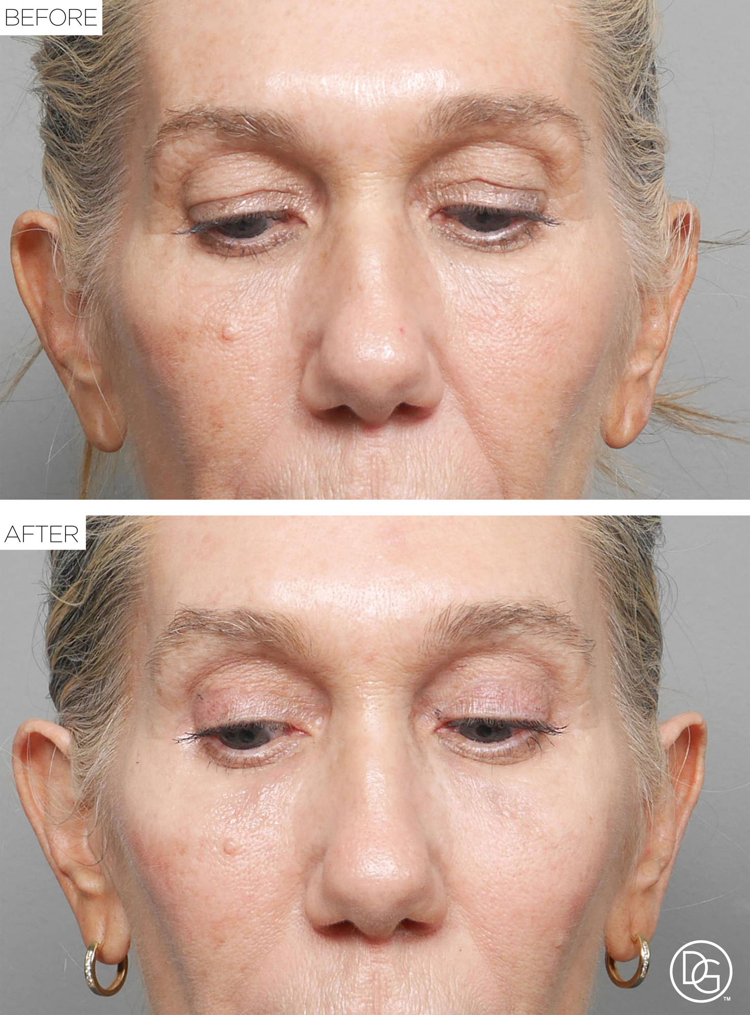 Blepharoplasty Before & After Image