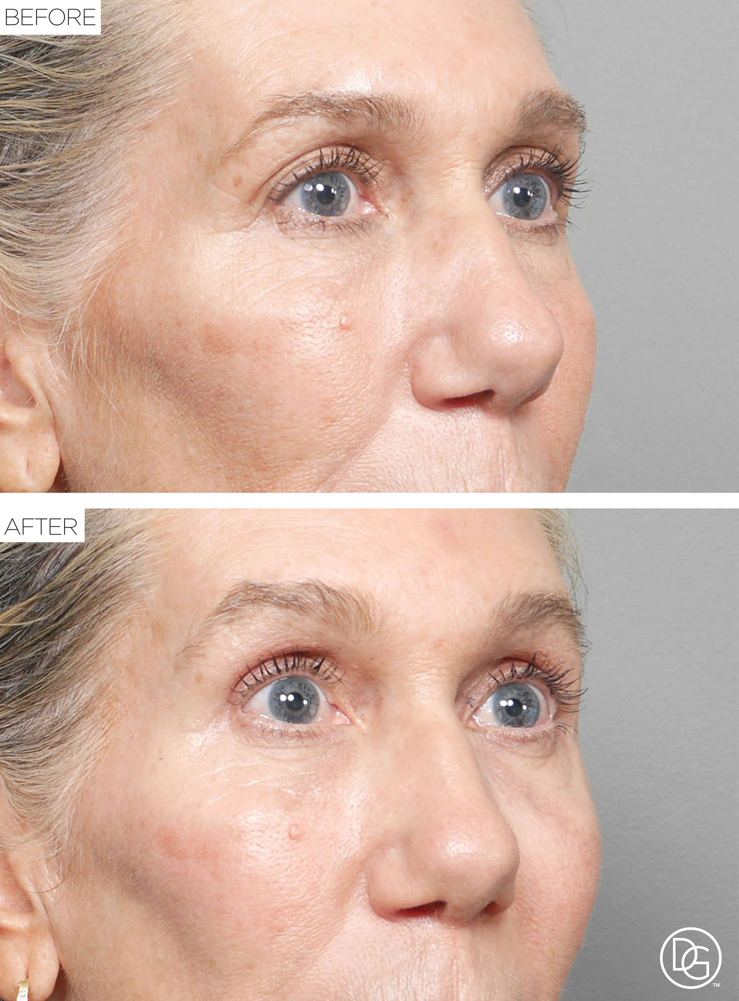 Blepharoplasty Before & After Image