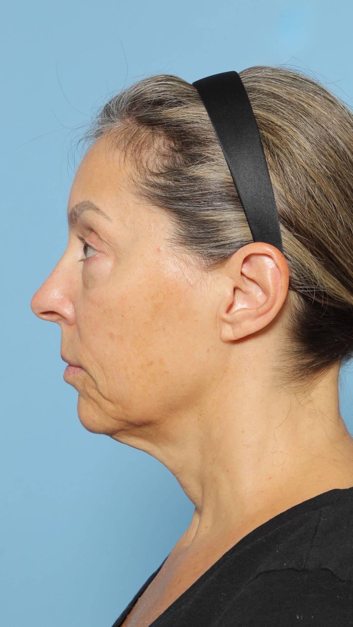 Before & After Image