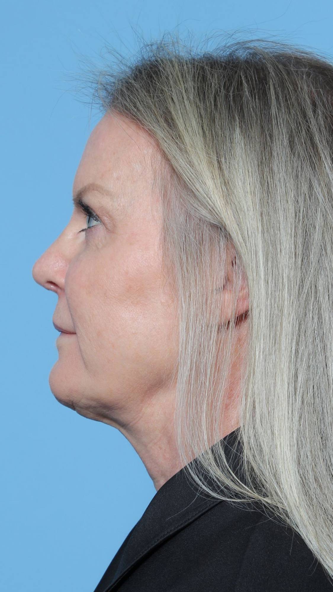 Nose Surgery Before & After Image