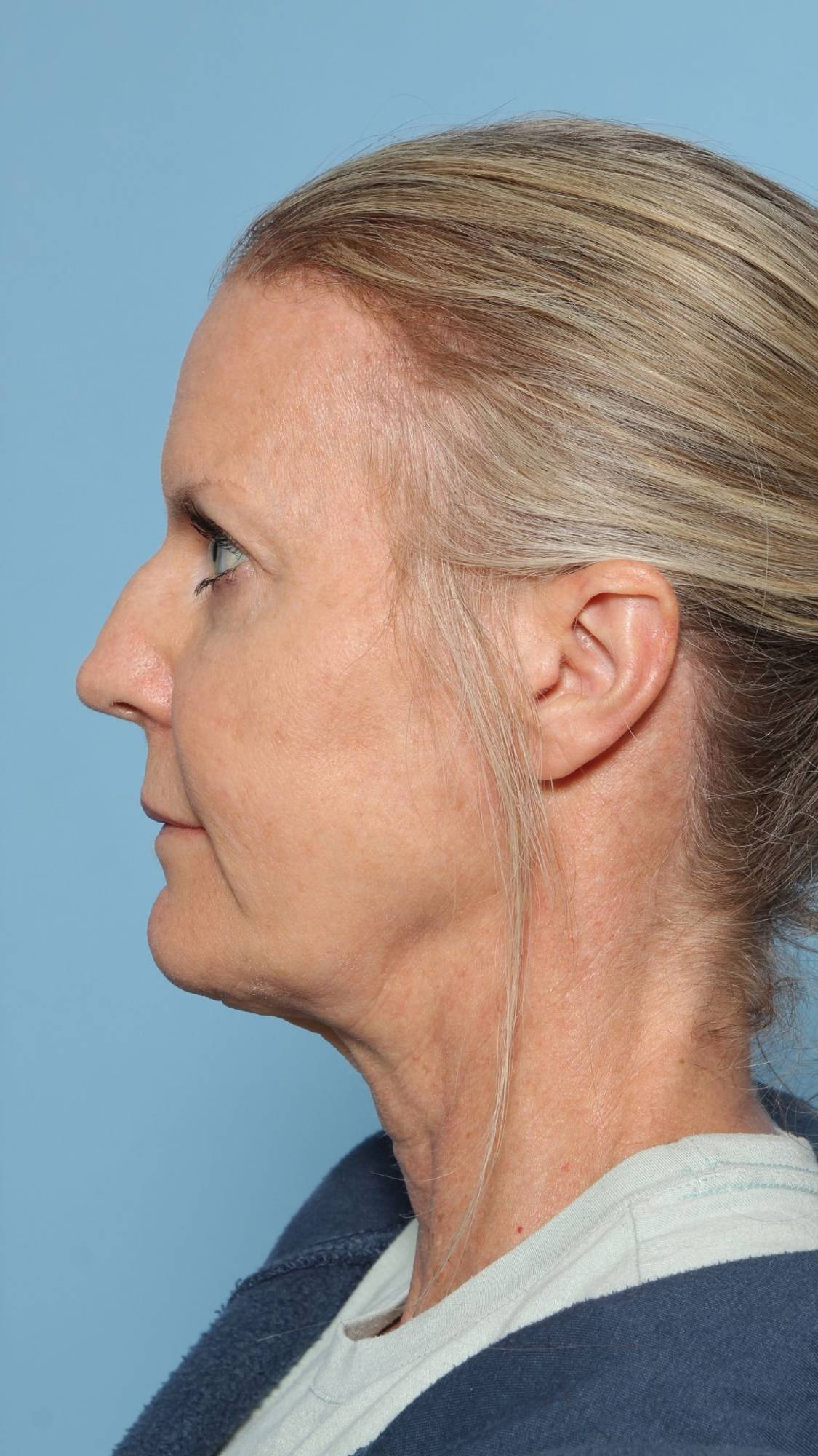 Nose Surgery Before & After Image