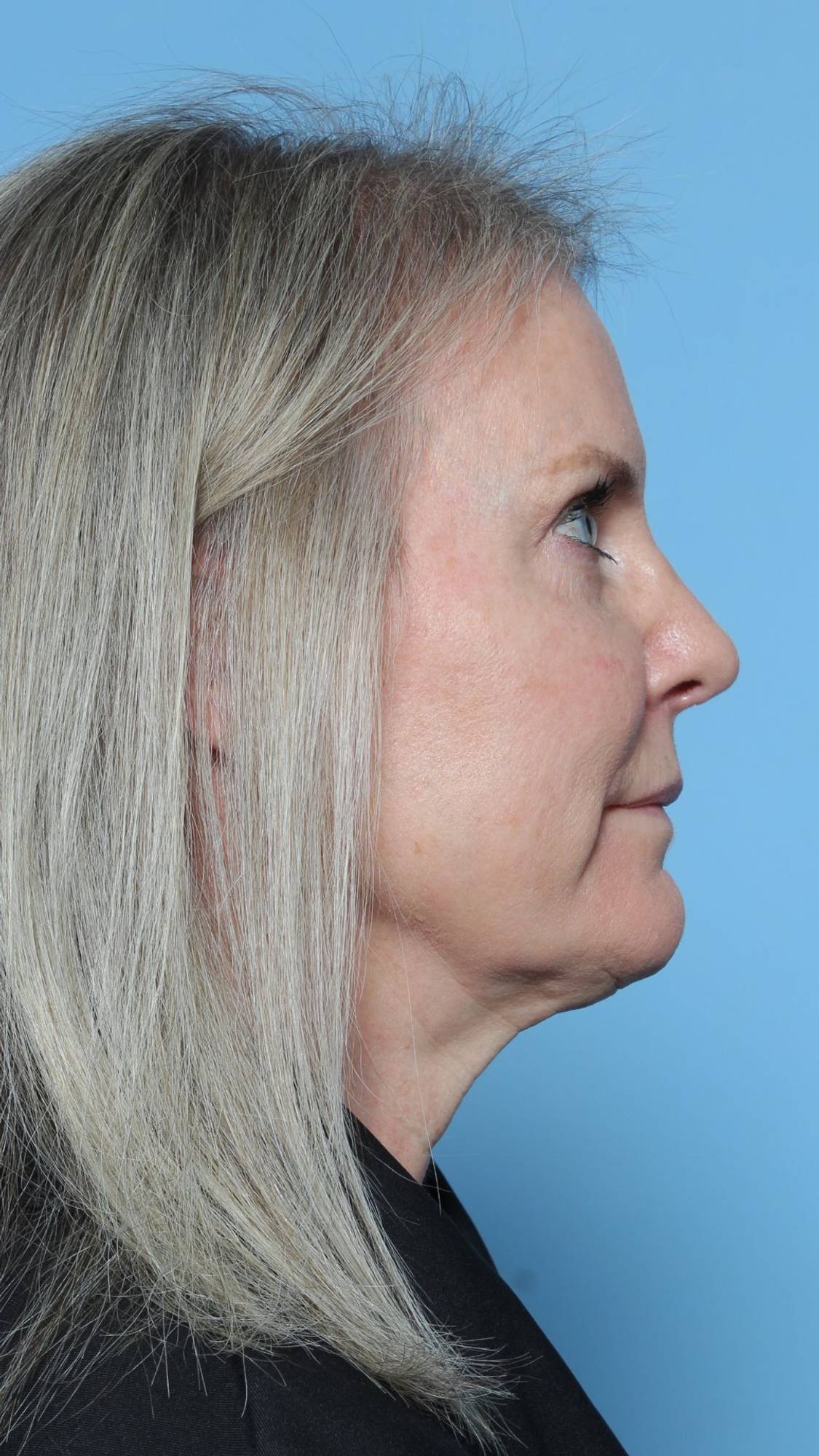 Before & After Image