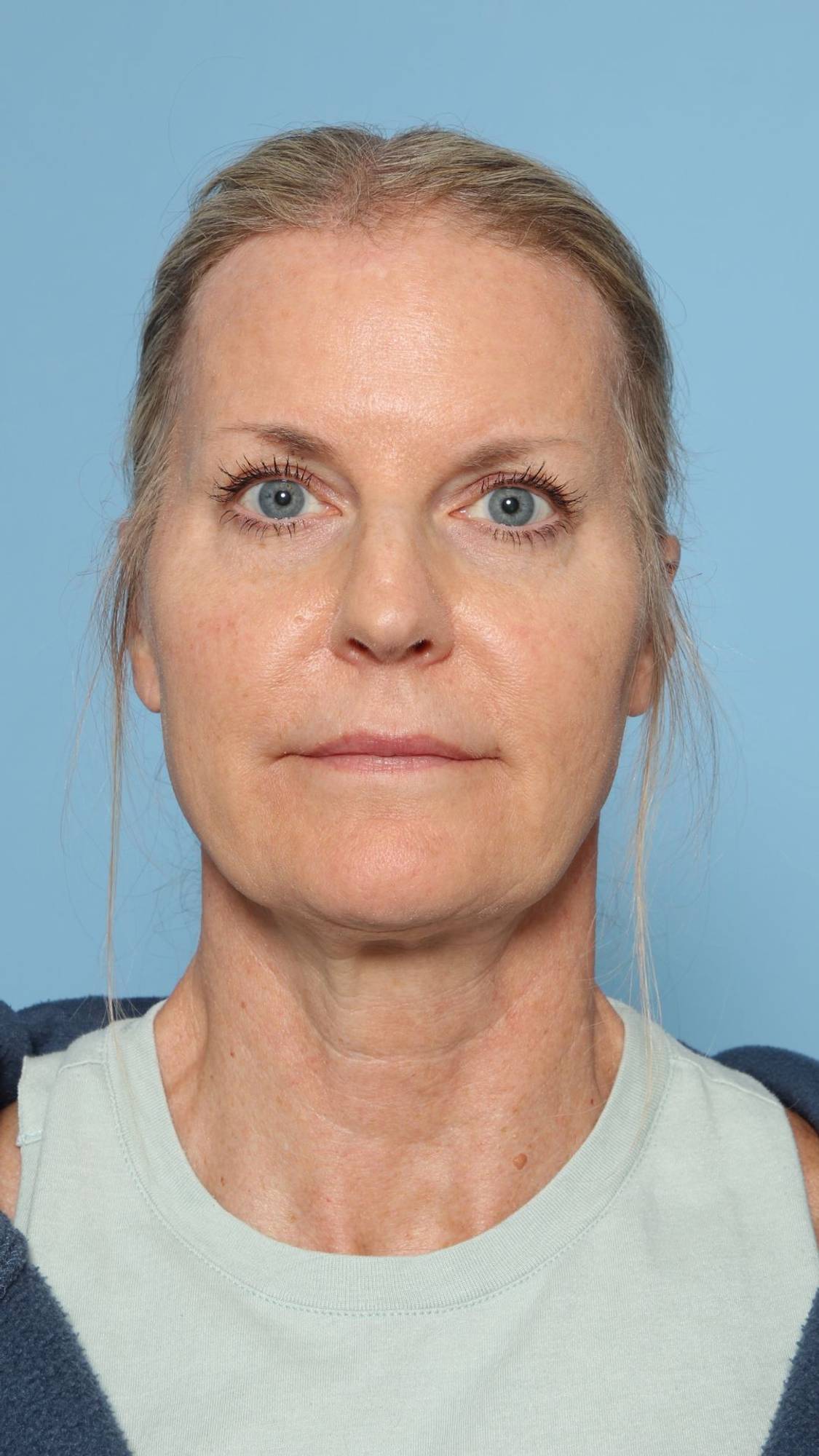 Nose Surgery Before & After Image