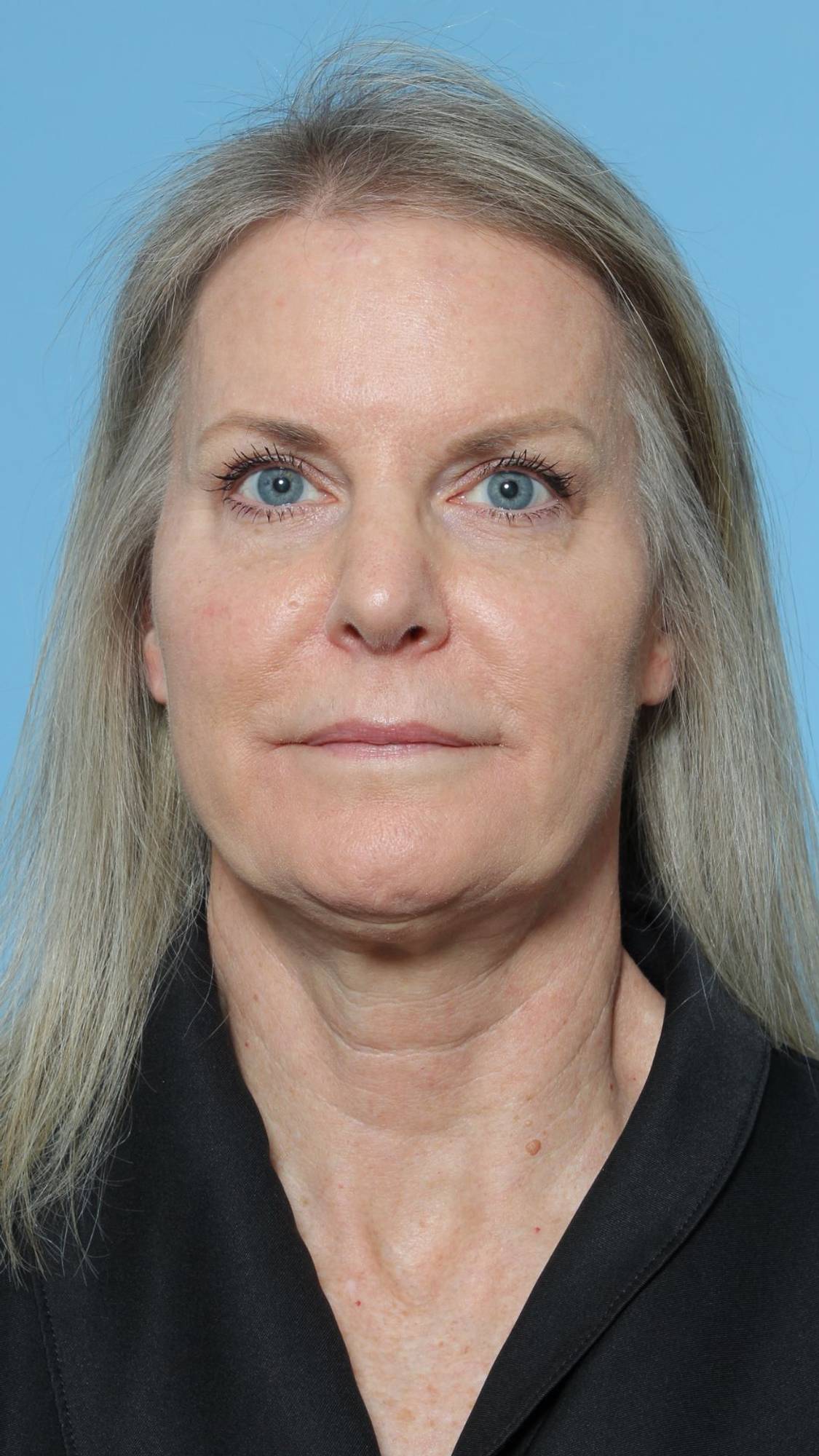 Nose Surgery Before & After Image