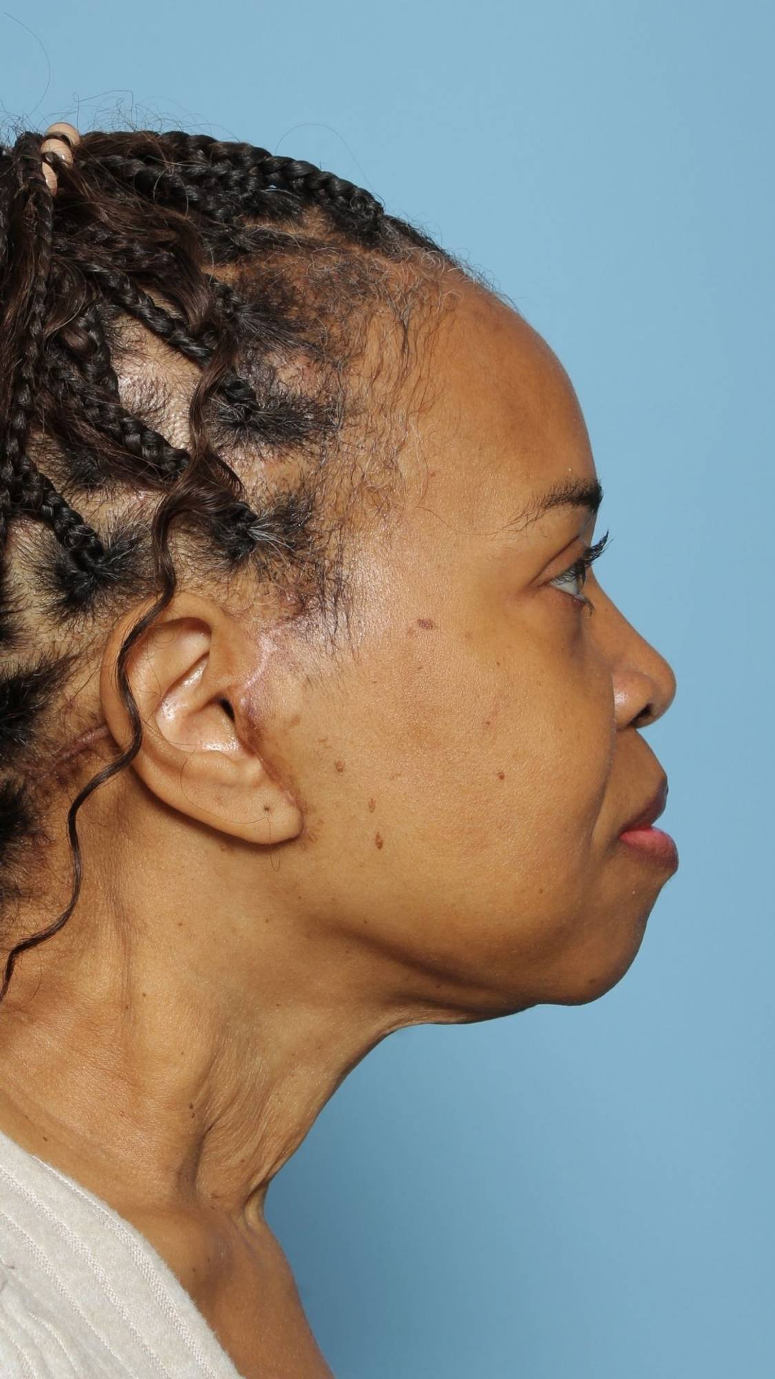 Facelift Before & After Image