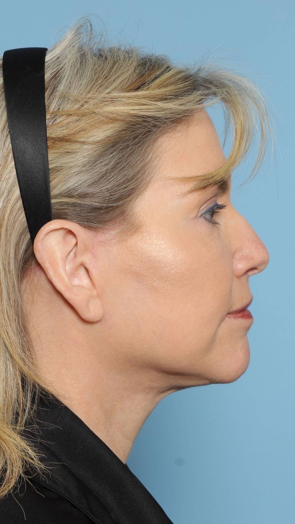 Neck Lift Before & After Image