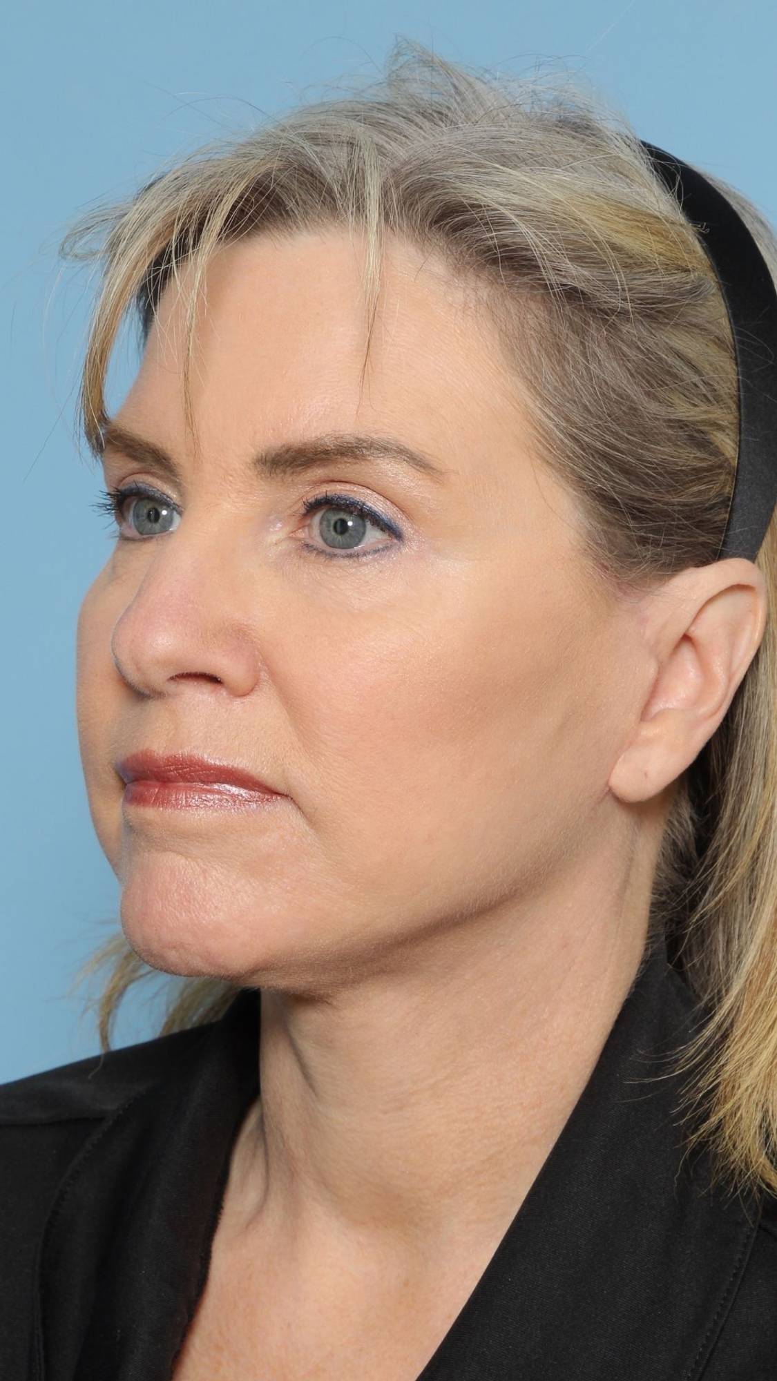 Neck Lift Before & After Image