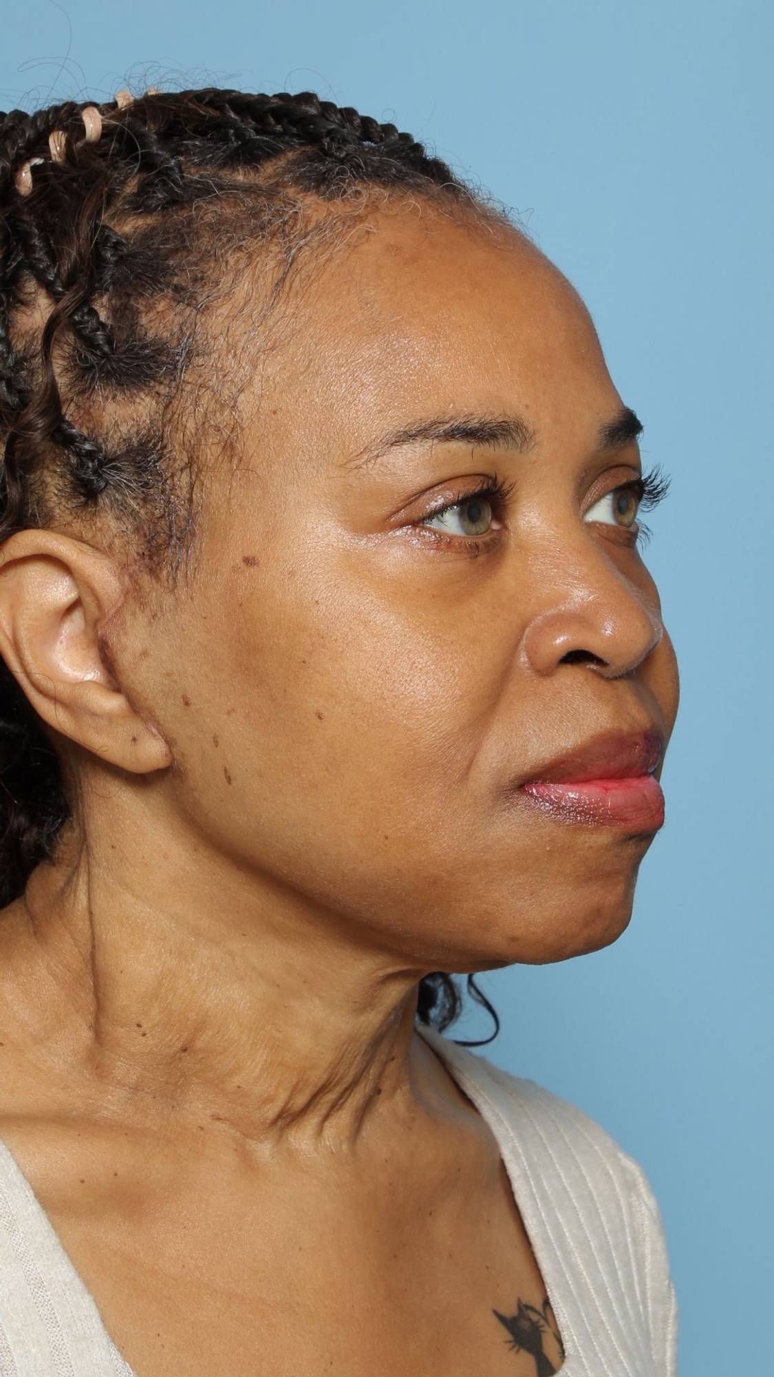 Facelift Before & After Image