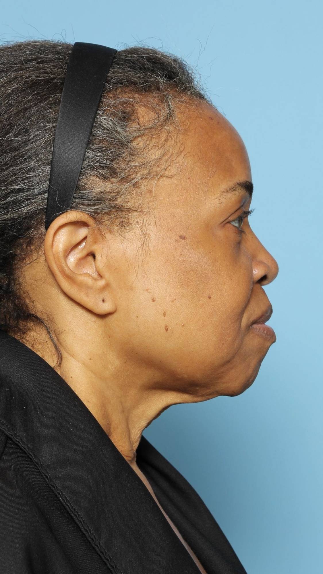 Facelift Before & After Image