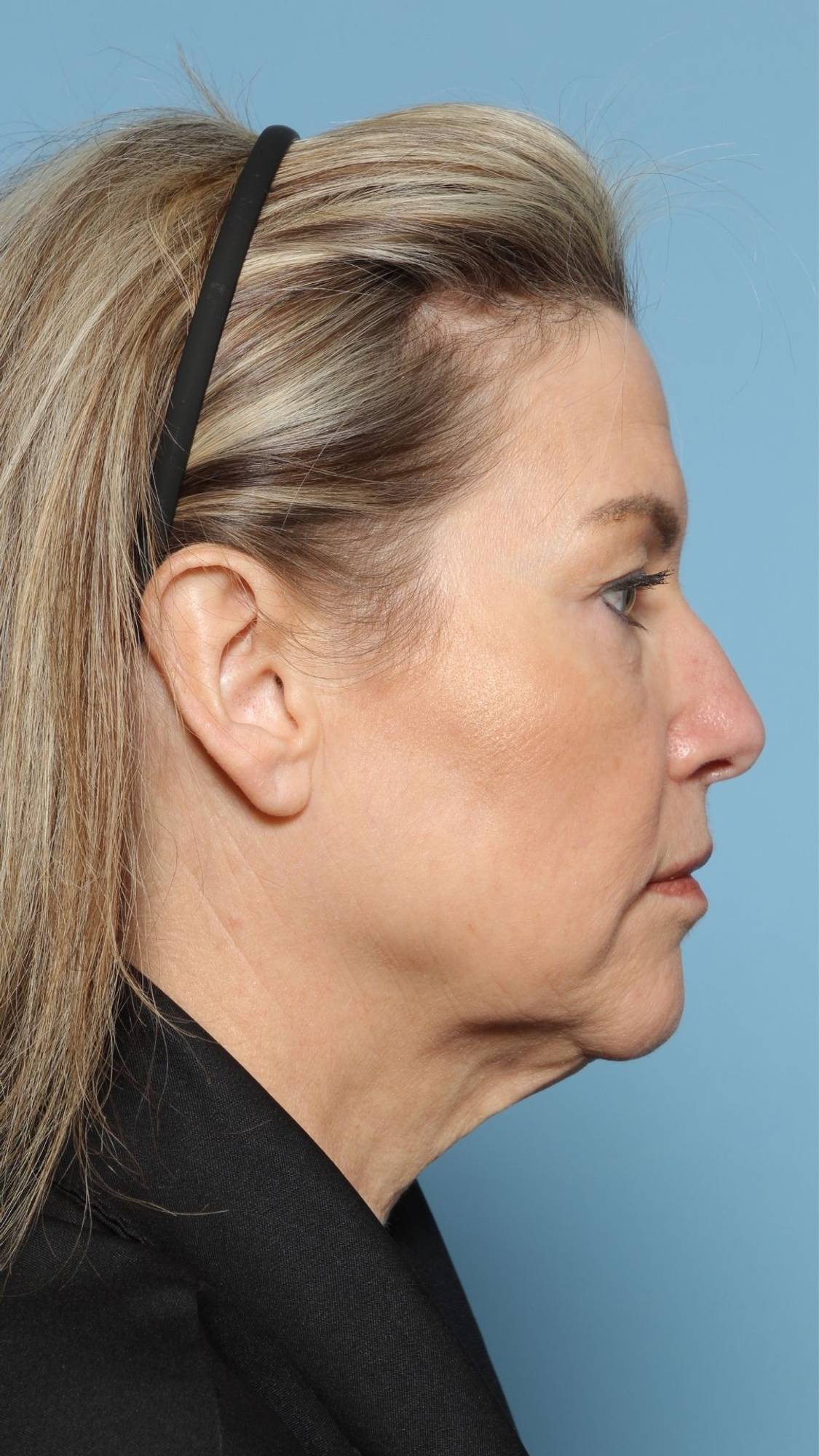 Neck Lift Before & After Image