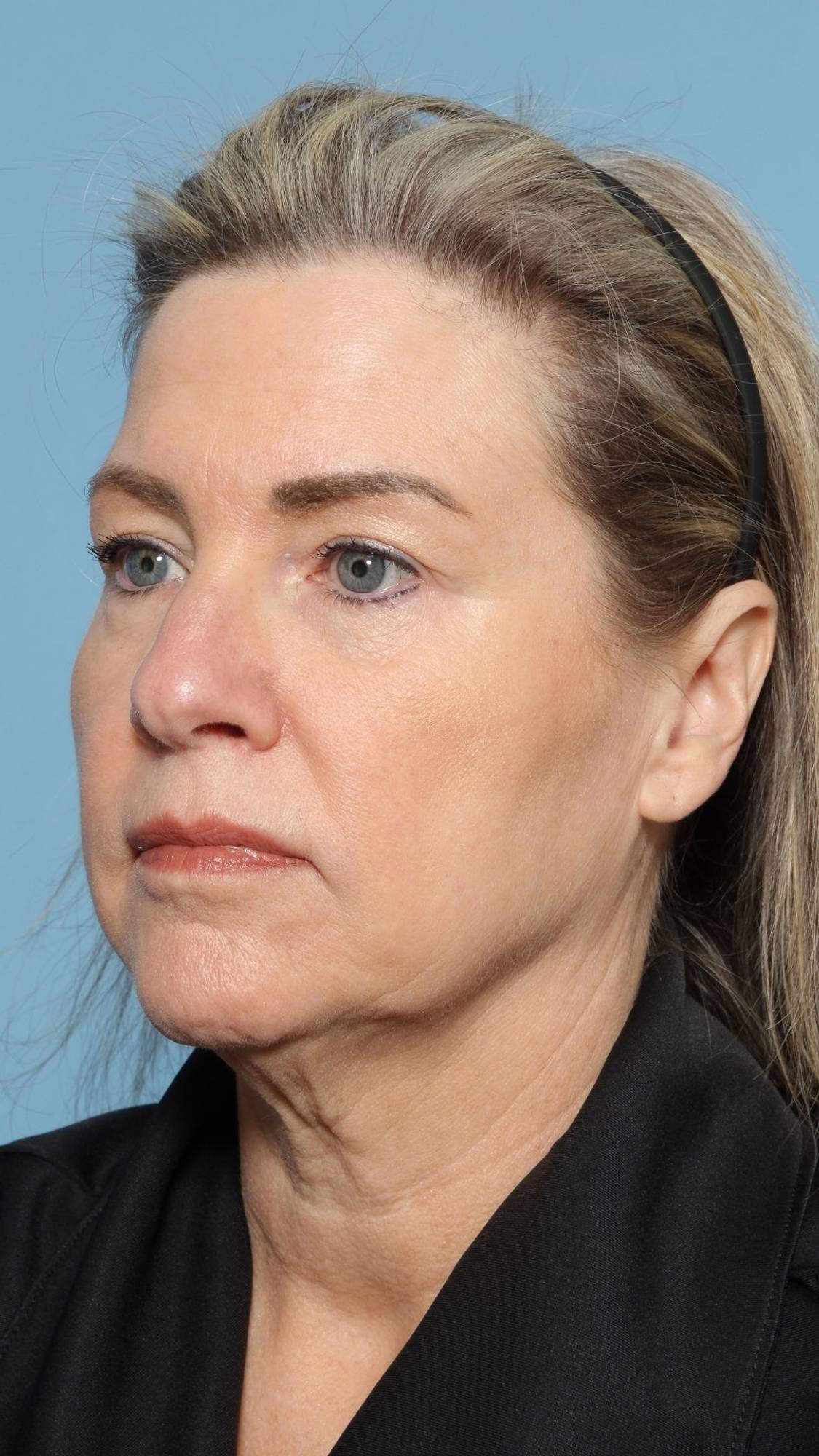 Facelift Before & After Image