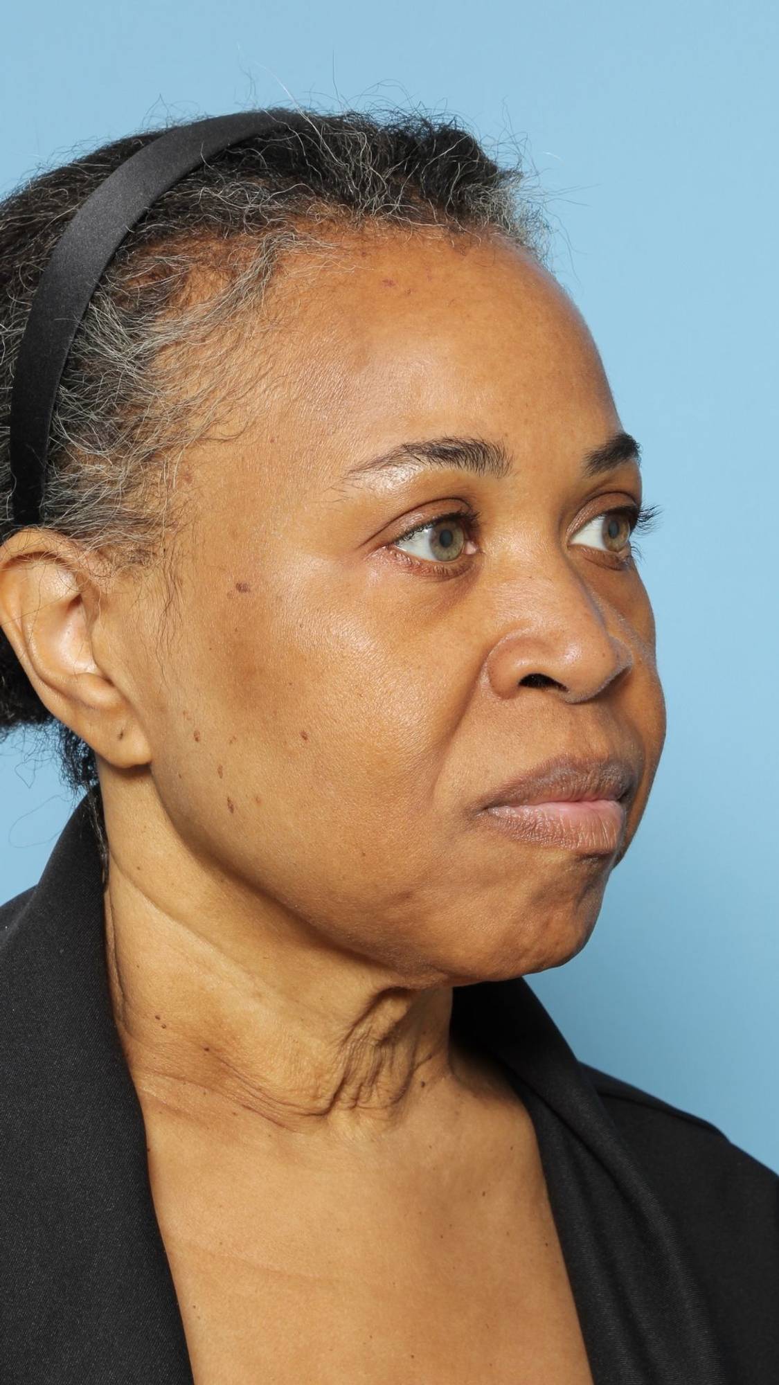 Facelift Before & After Image