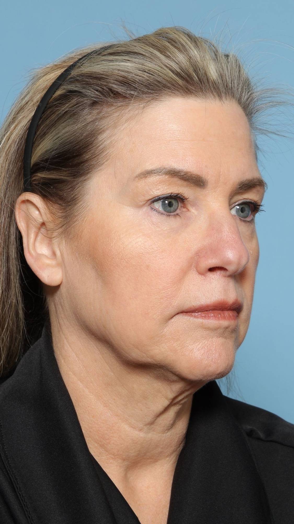 Facelift Before & After Image