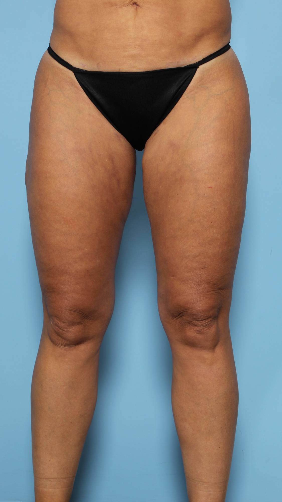 Liposuction Before & After Image