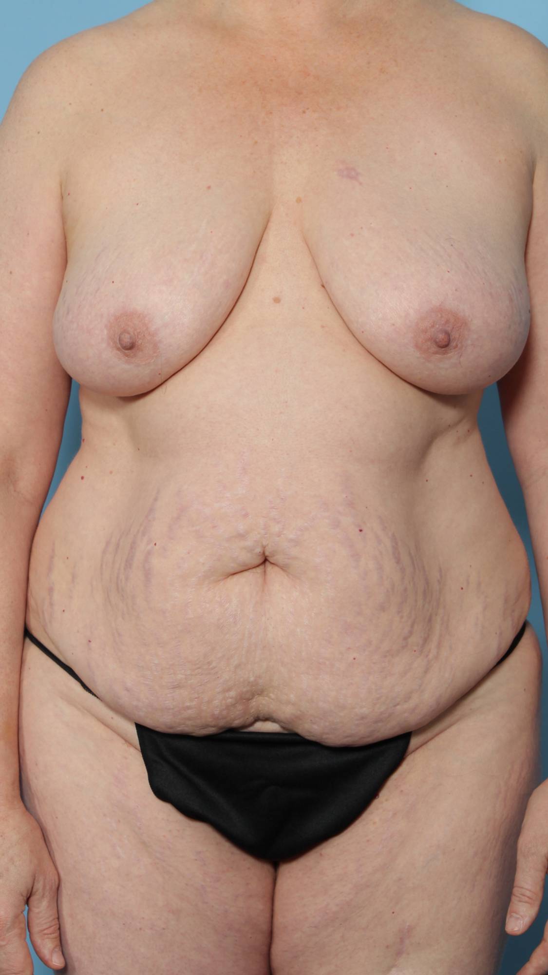 Mommy Makeover Before & After Image