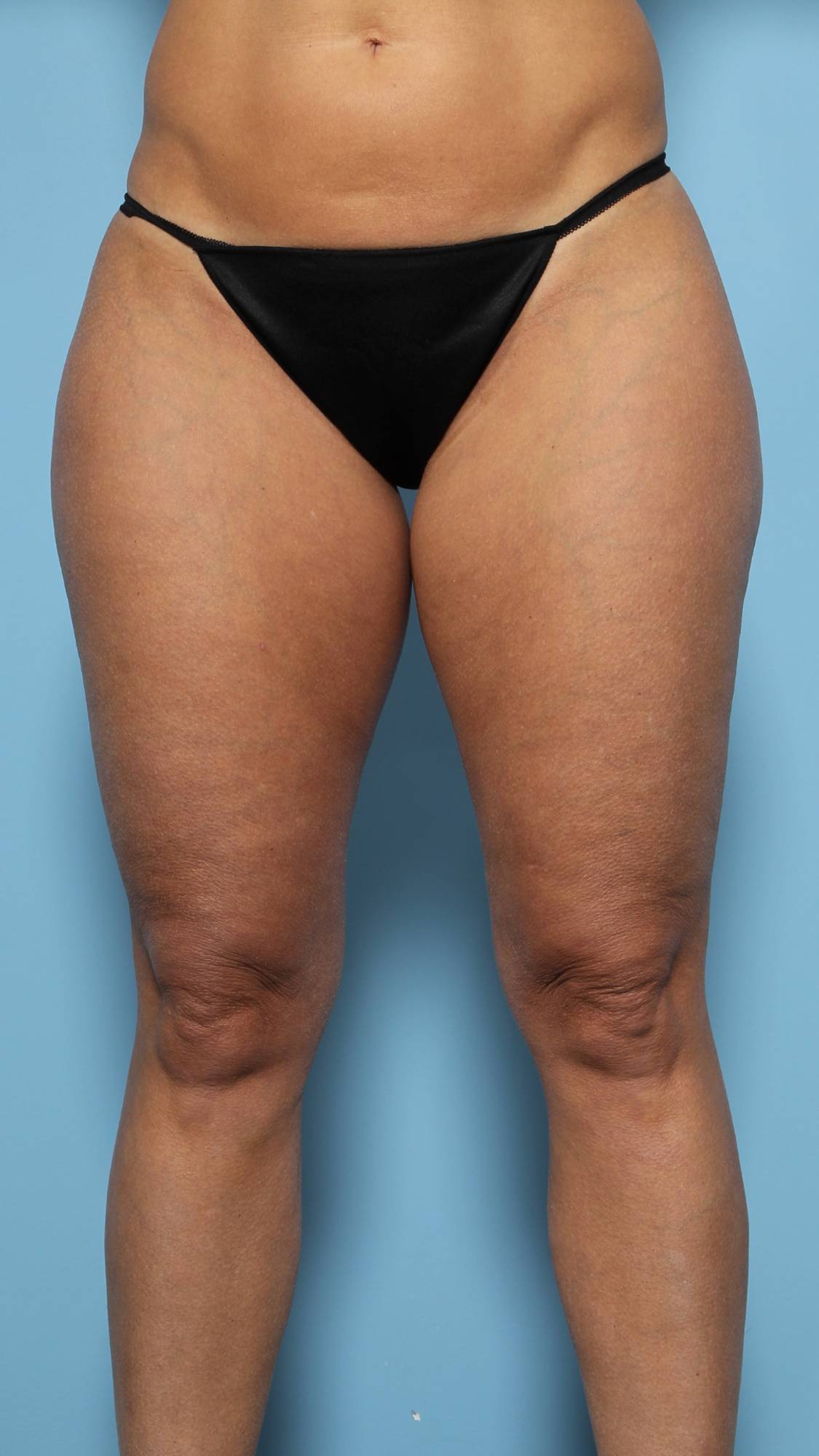 Liposuction Before & After Image
