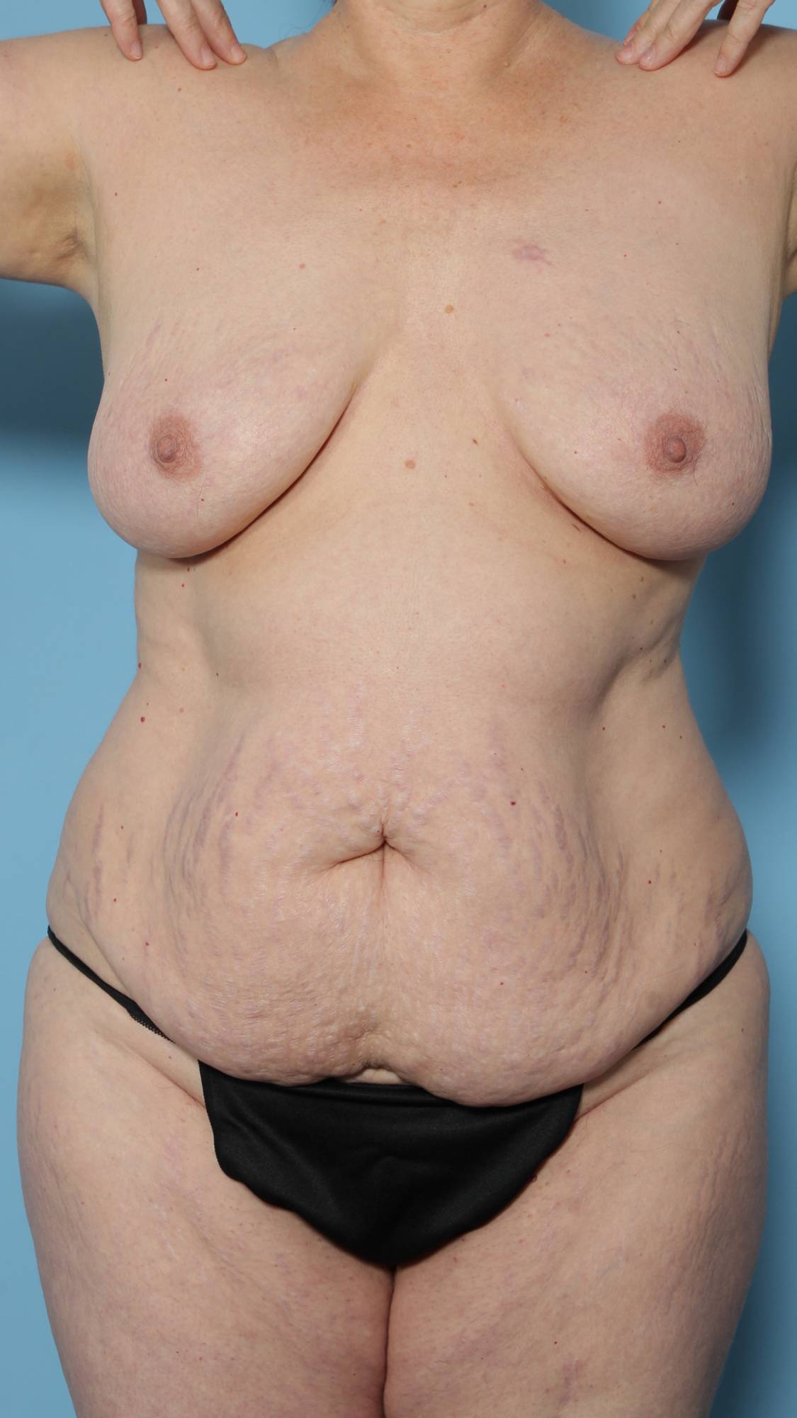 Mommy Makeover Before & After Image