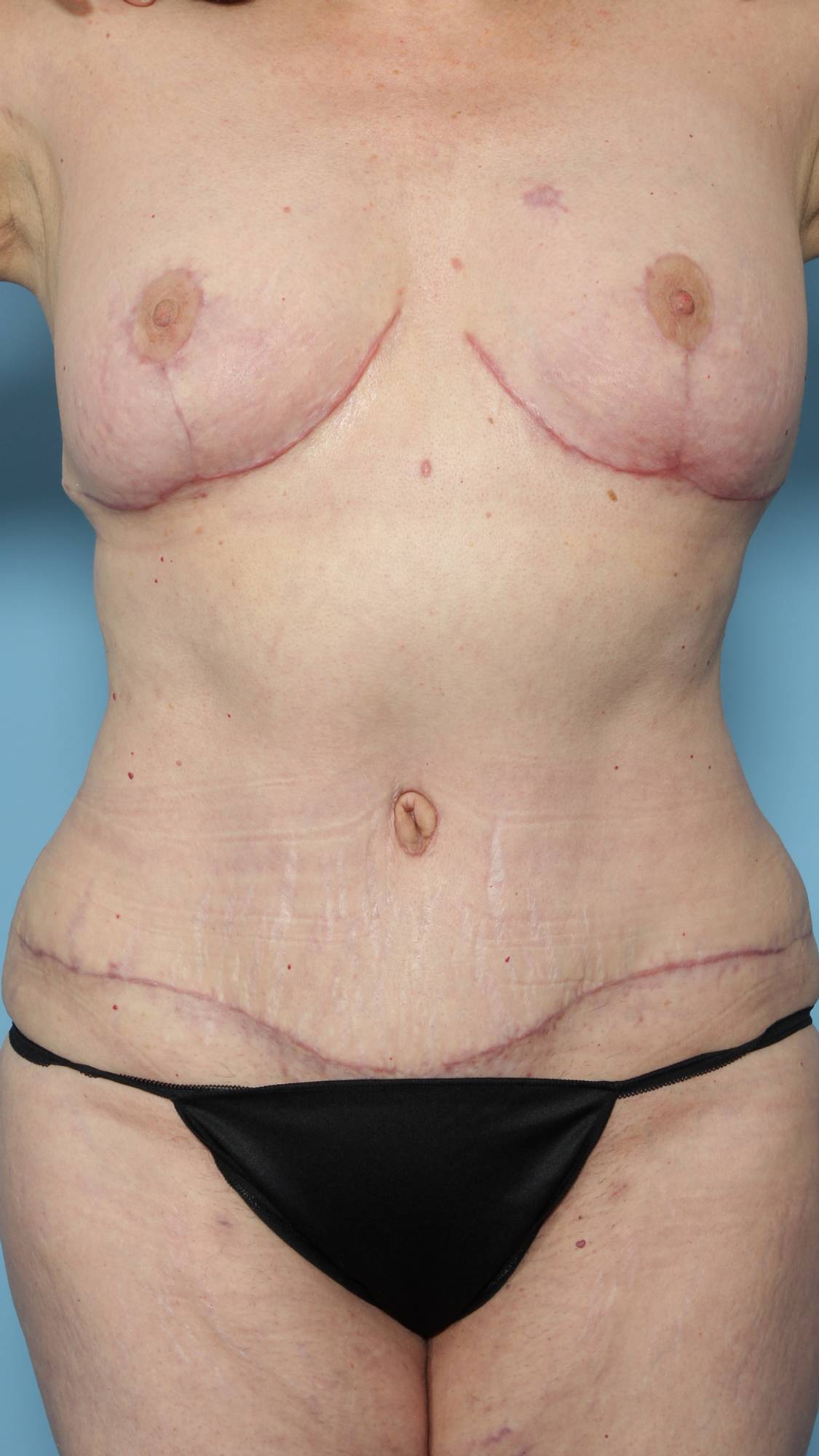 Mommy Makeover Before & After Image