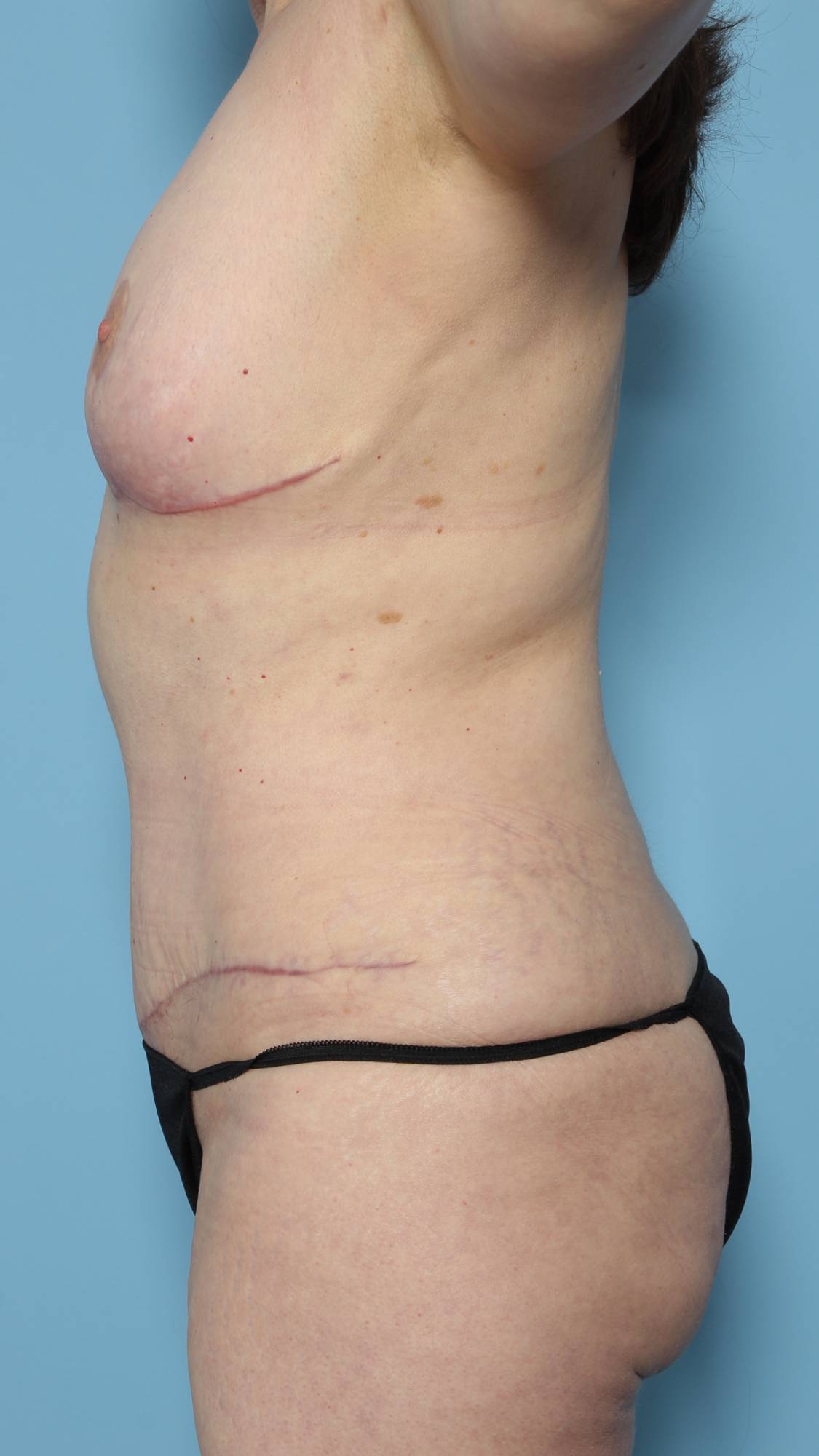 Mommy Makeover Before & After Image