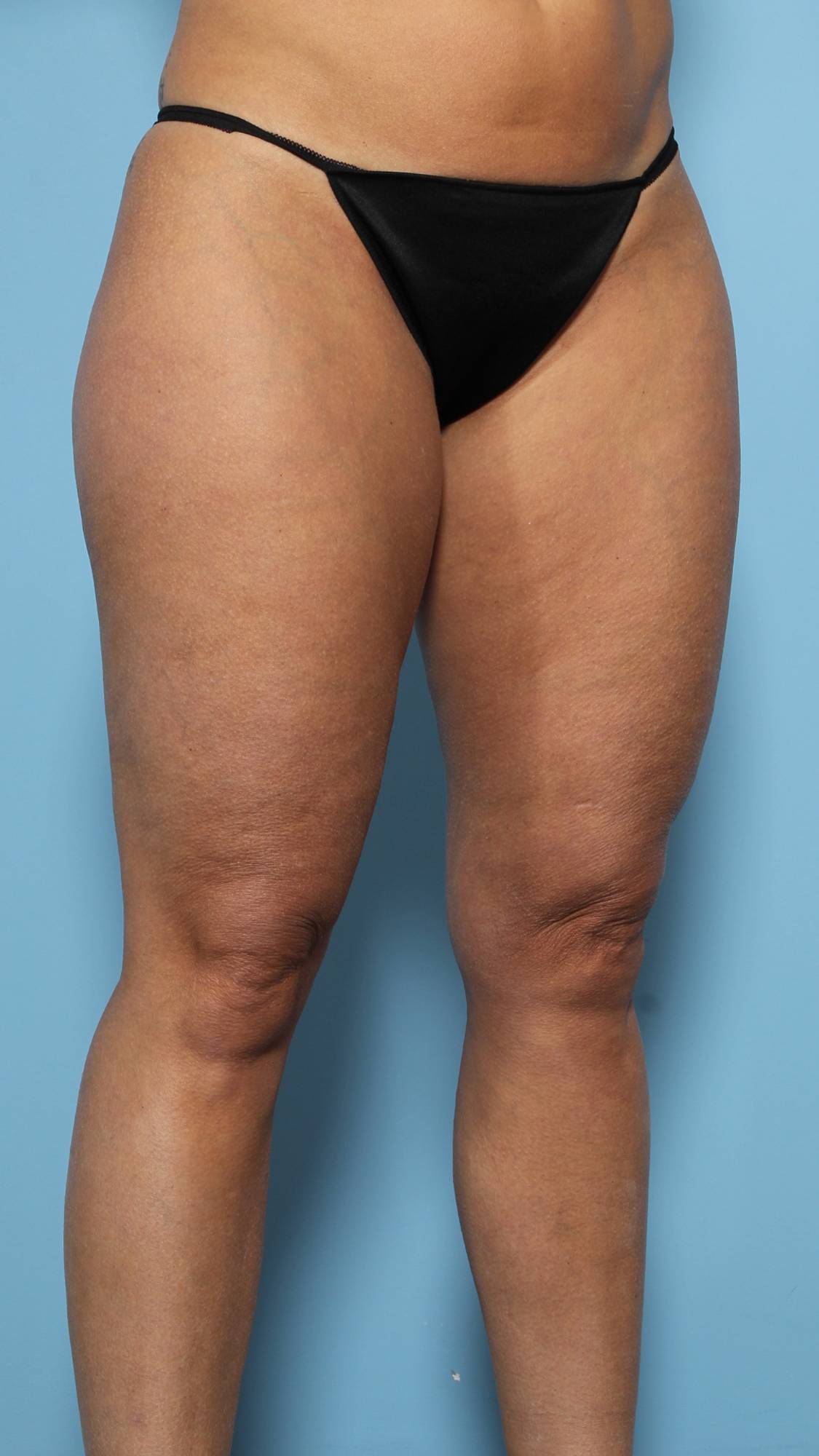 Liposuction Before & After Image