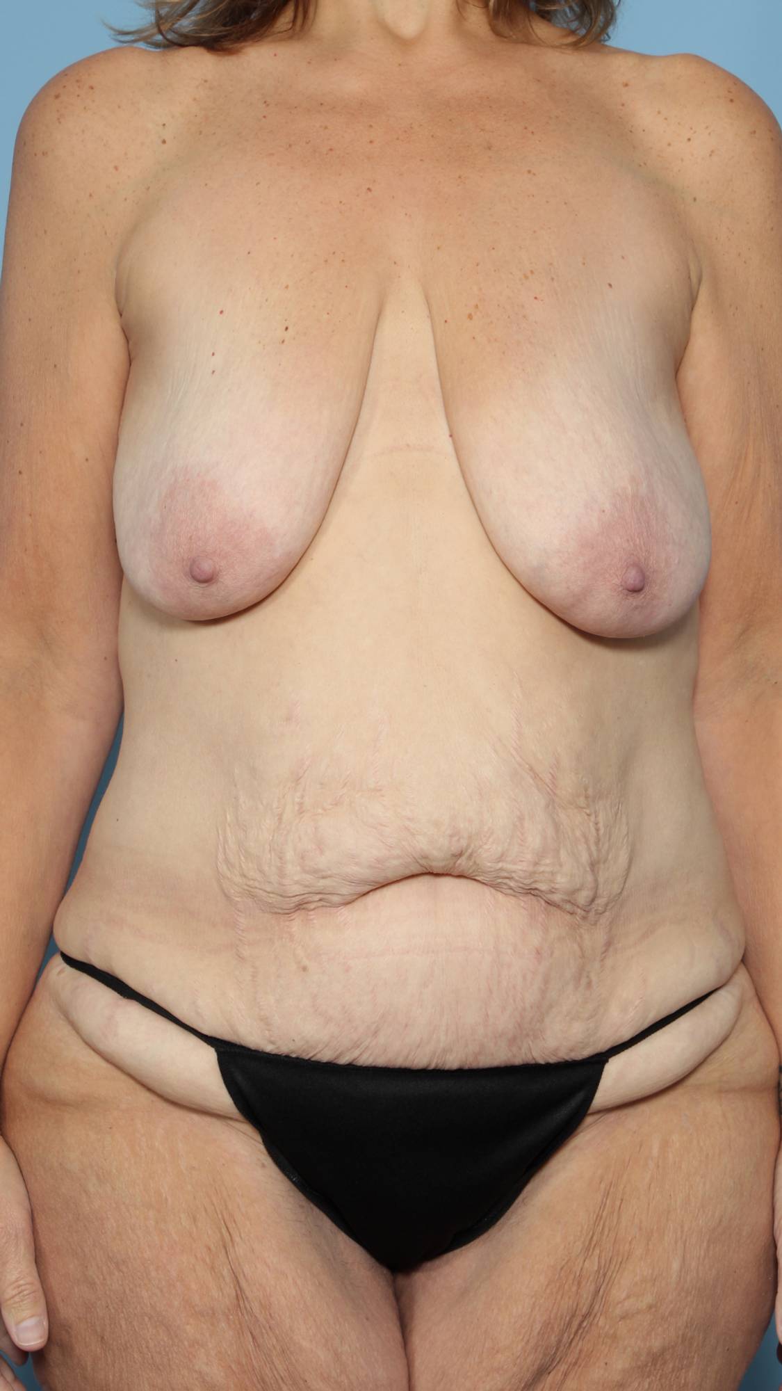 Breast Lift Before & After Image