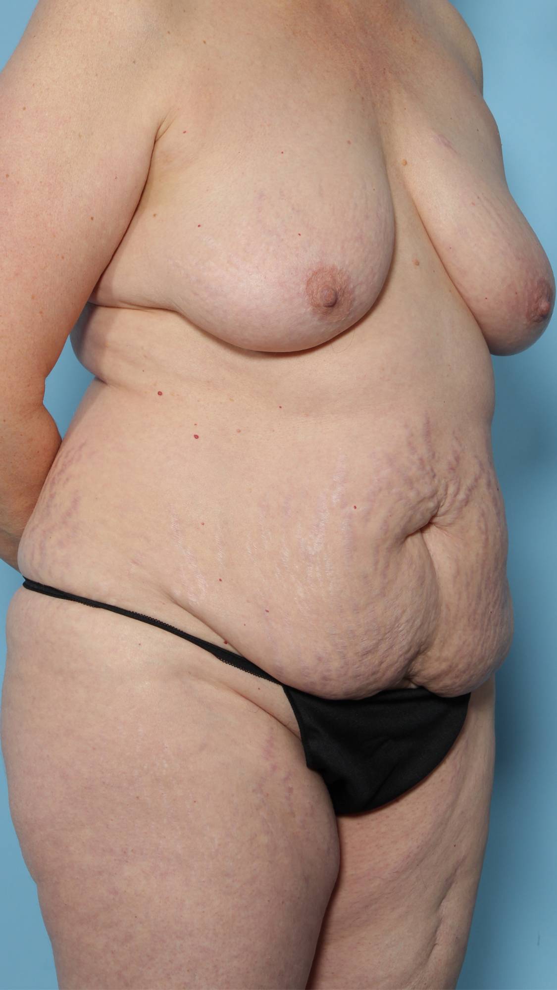 Mommy Makeover Before & After Image