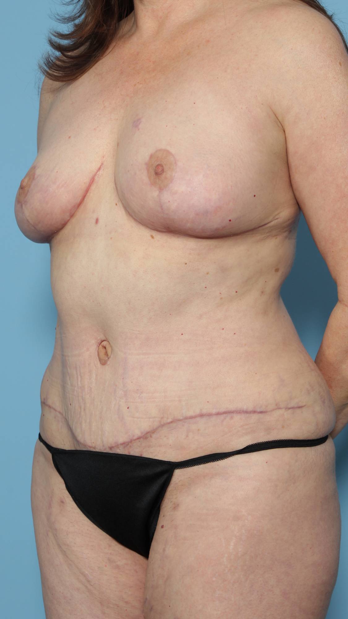 Mommy Makeover Before & After Image