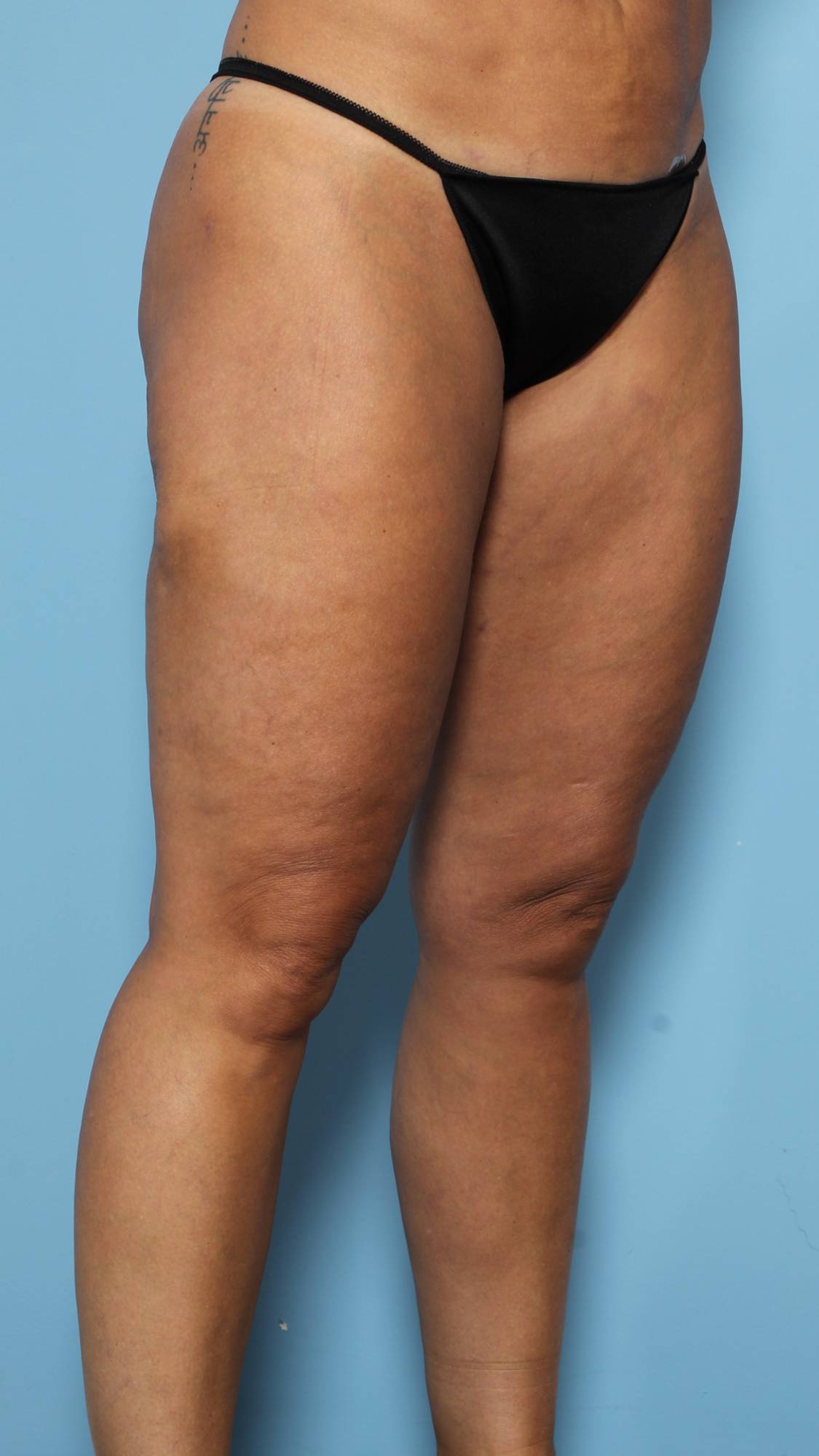 Liposuction Before & After Image