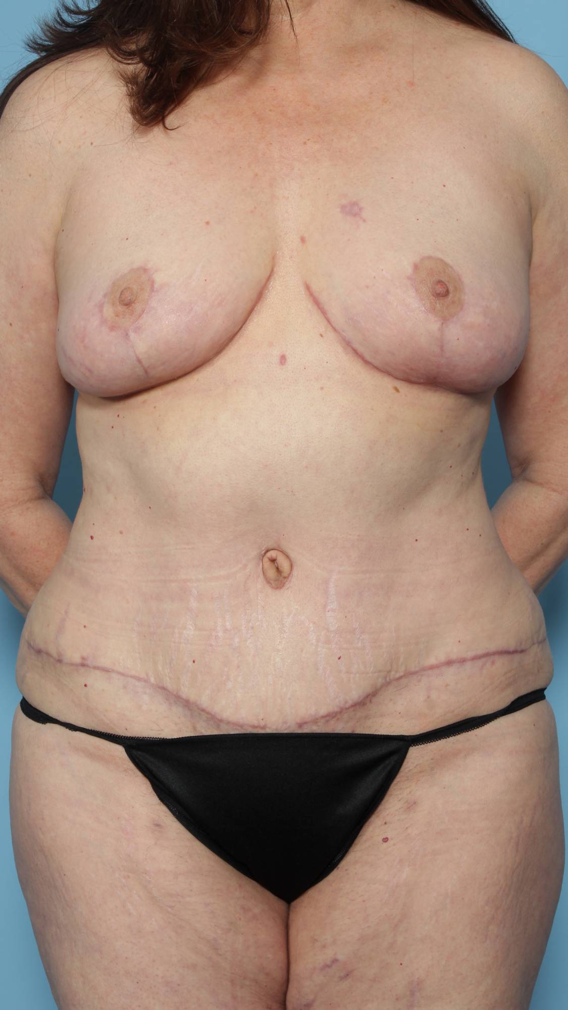 Mommy Makeover Before & After Image