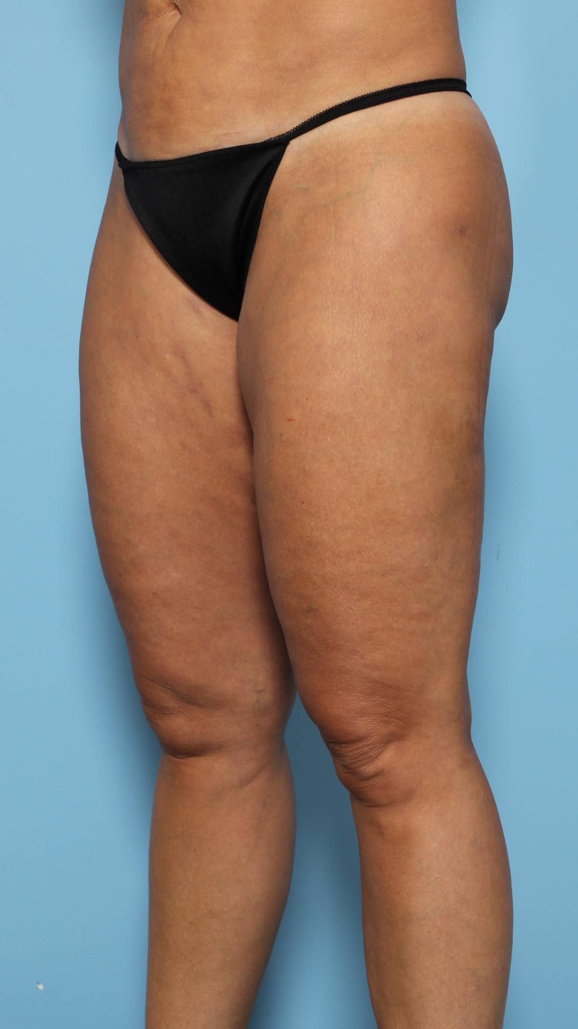 Liposuction Before & After Image