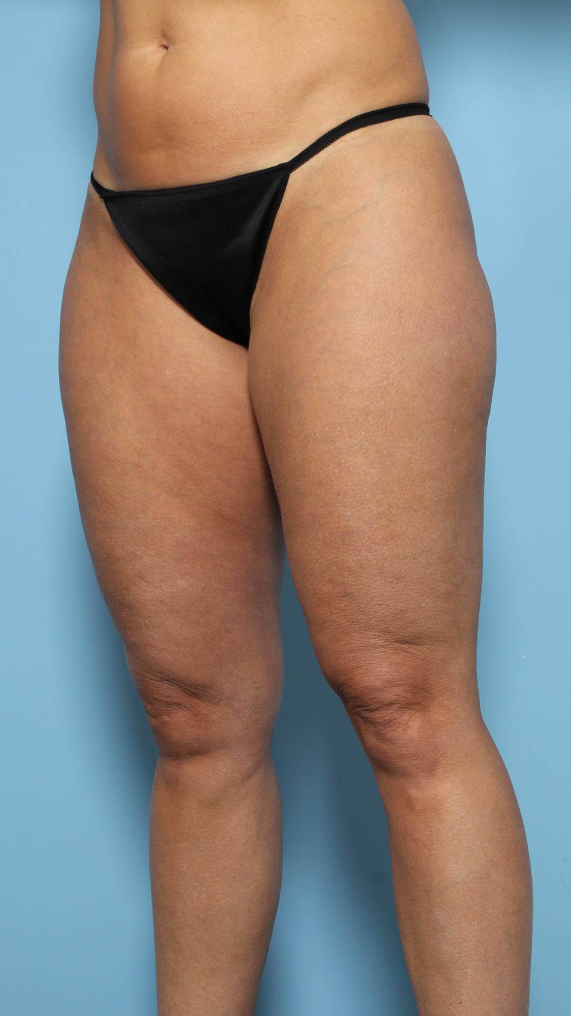 Liposuction Before & After Image
