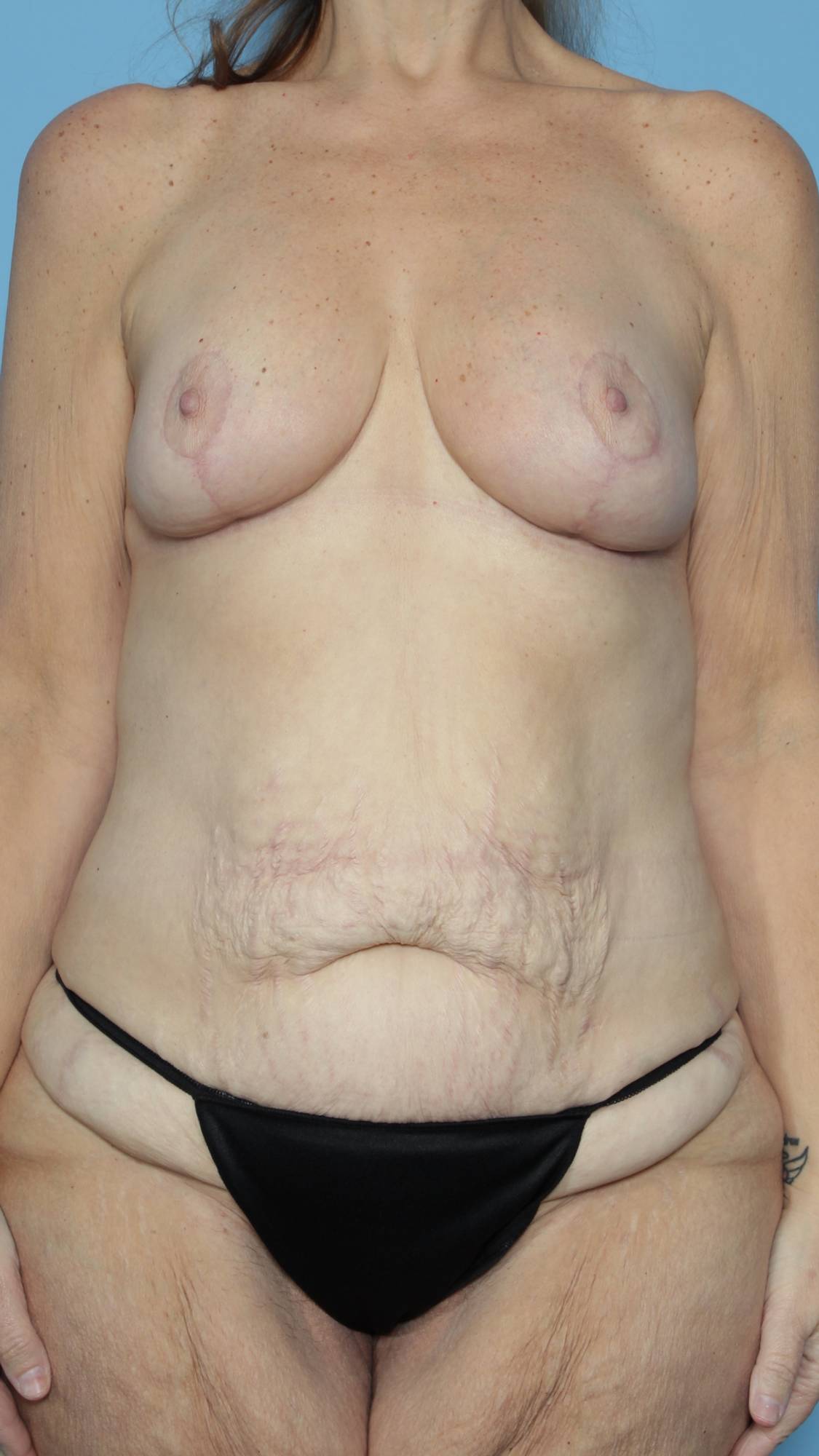 Breast Lift Before & After Image