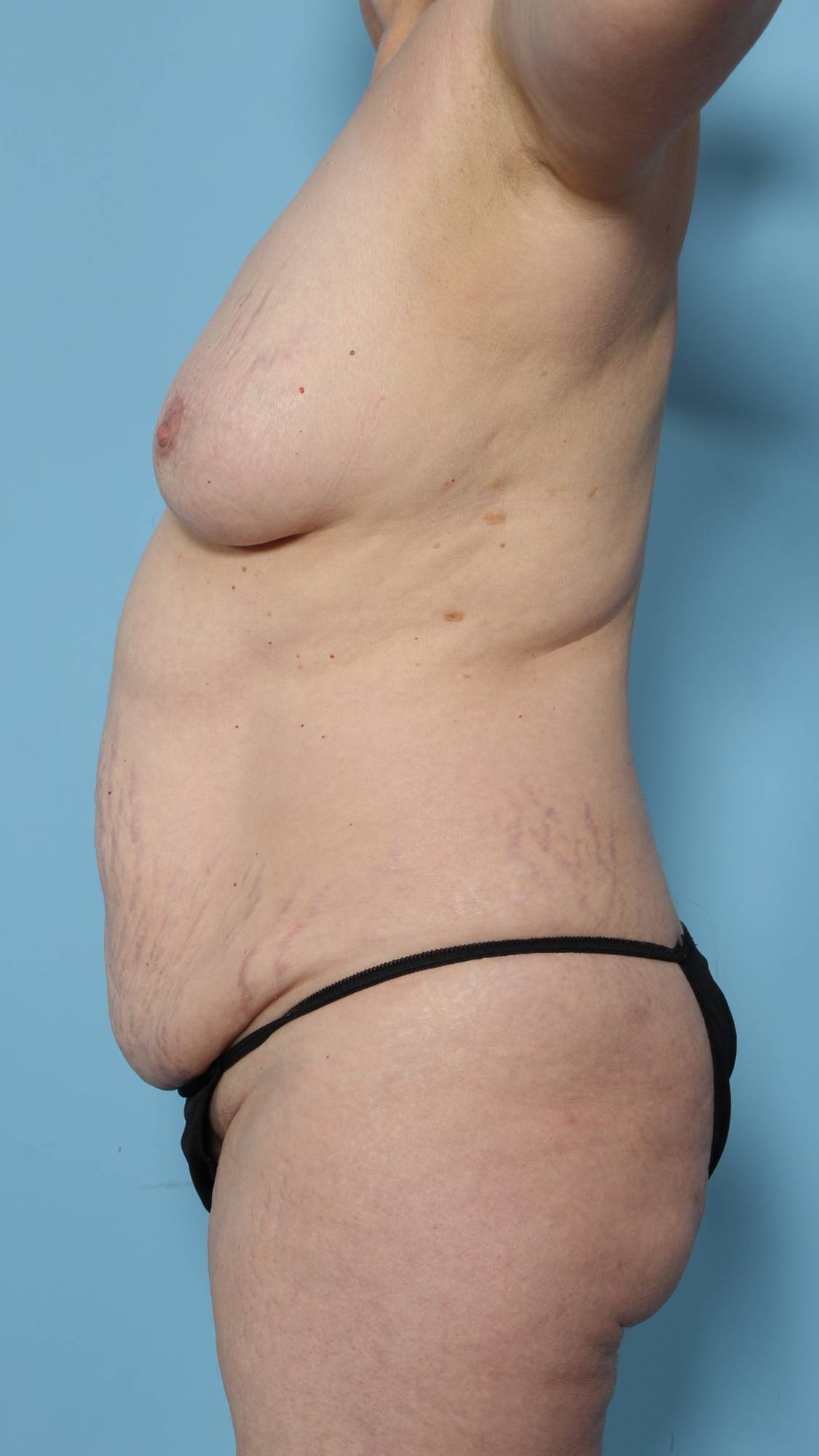 Mommy Makeover Before & After Image