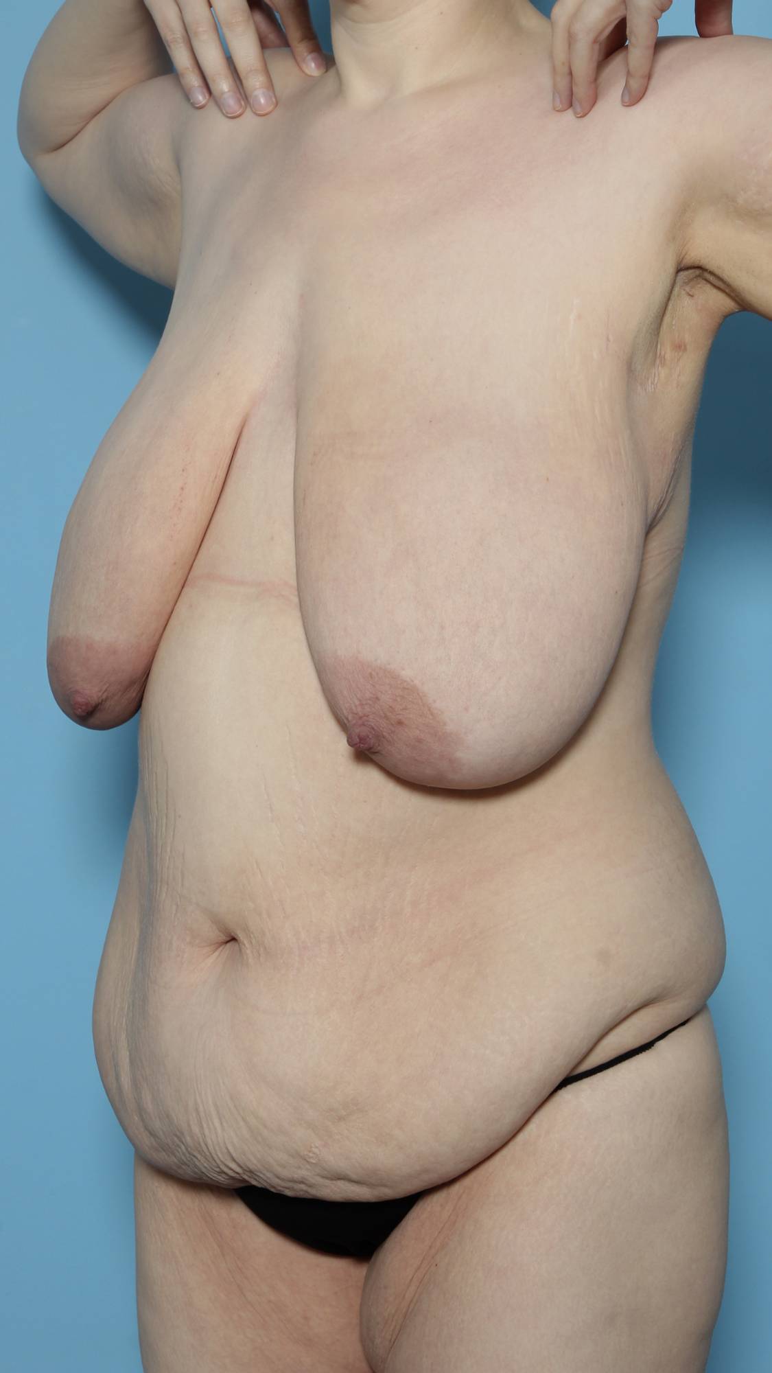 Breast Reduction Before & After Image