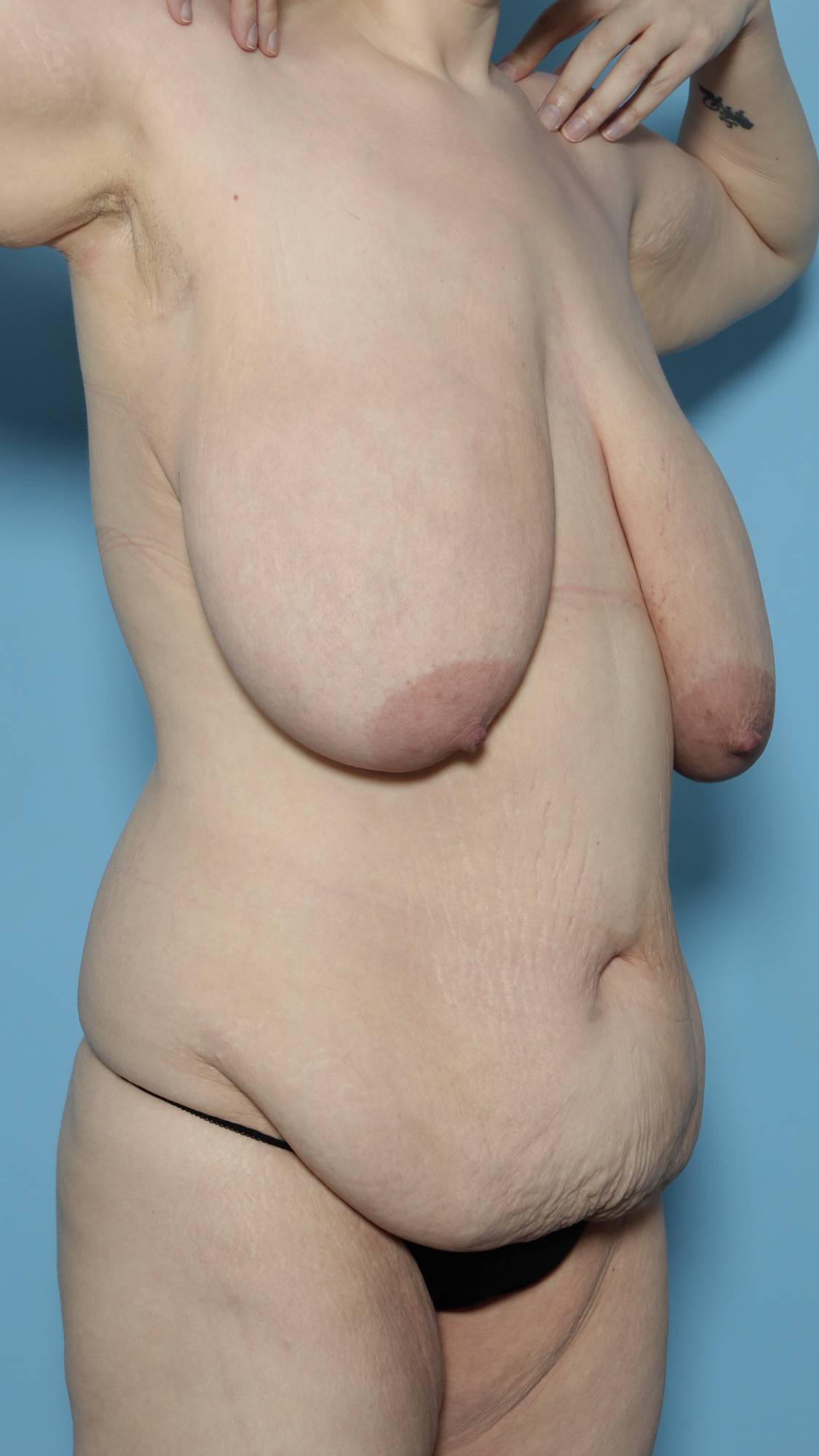 Breast Reduction Before & After Image