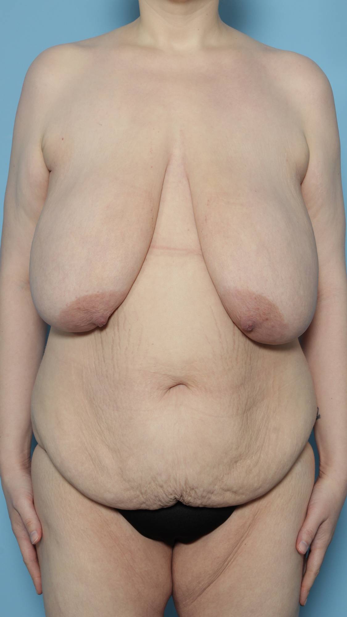 Breast Reduction Before & After Image