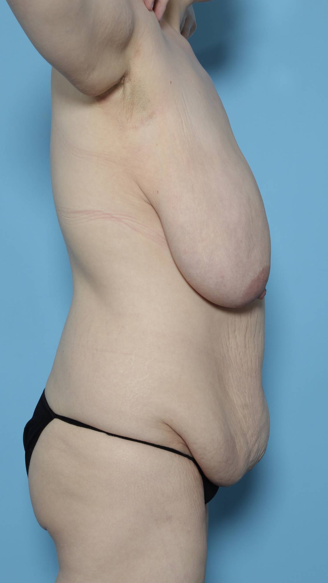 Breast Reduction Before & After Image